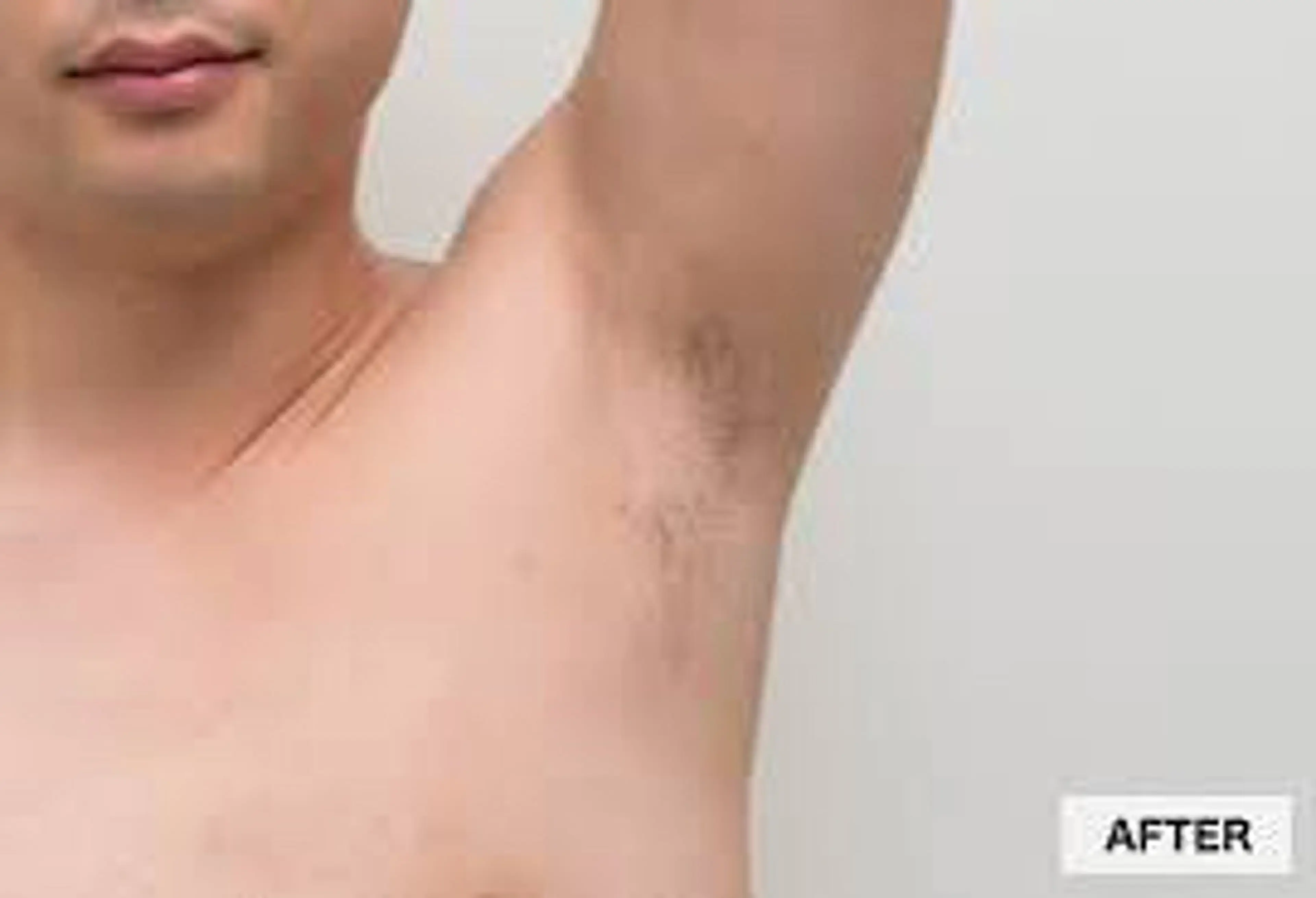 男性脱毛　Ｓパーツ（手の甲指/足の甲指/口周り/わき）の写真