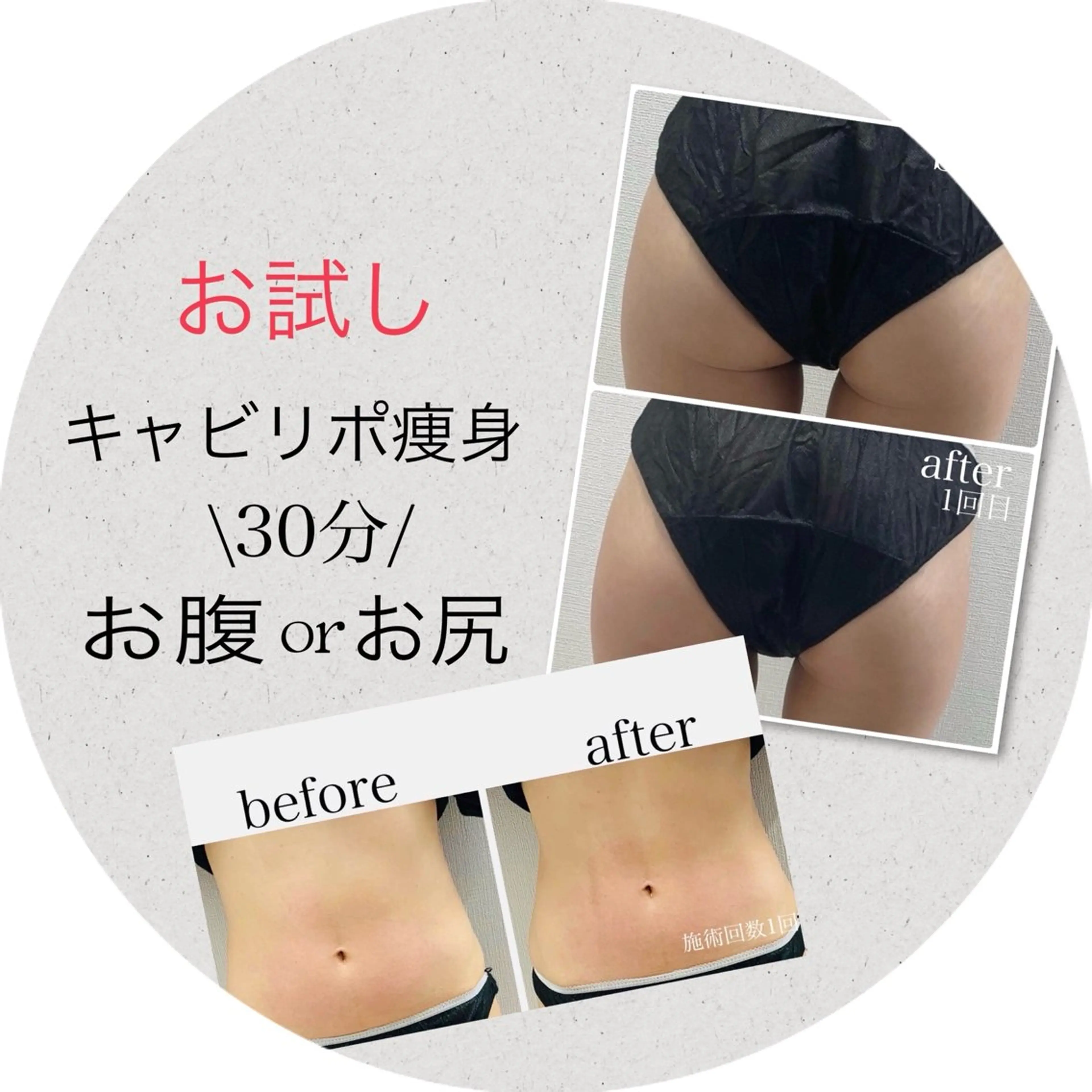 2名様様限定⭐️キャビリポ痩身お腹orお尻✨モニター募集　4000円の写真