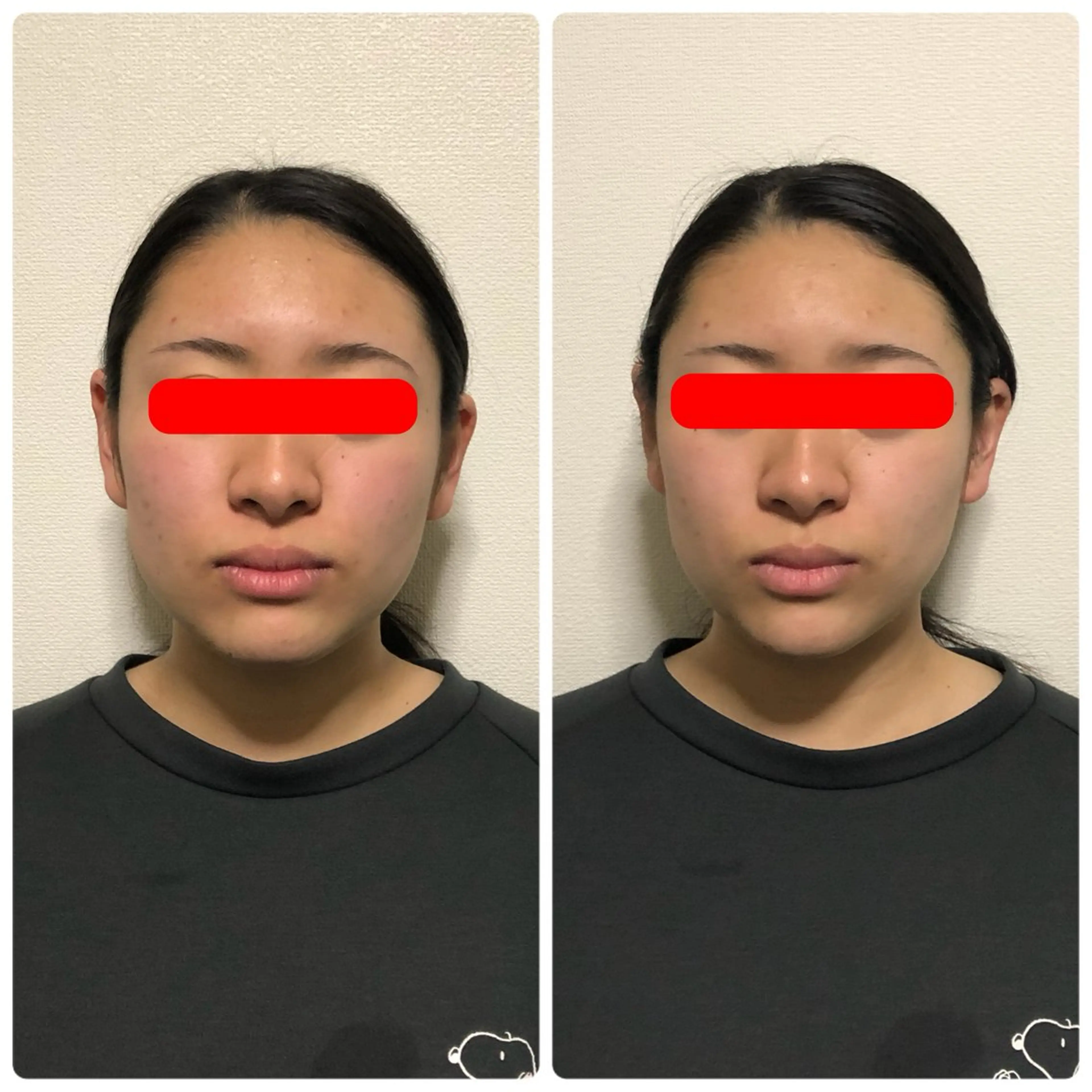 新規のお客様限定❗️小顔コース（90分）の写真