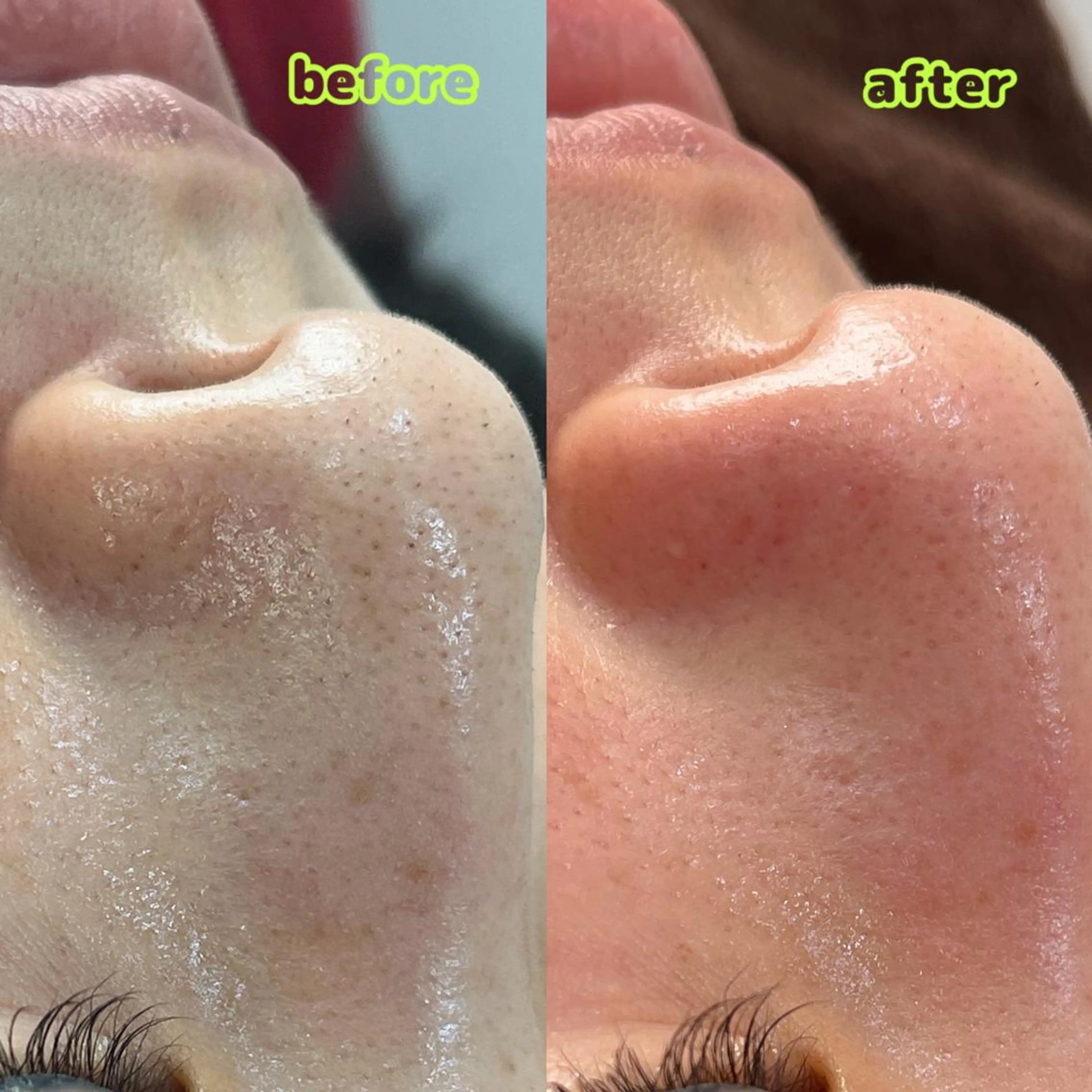 黒ずみ・ザラつきにお悩みの方- ̗̀📣《毛穴洗浄(全顔)》！！の写真