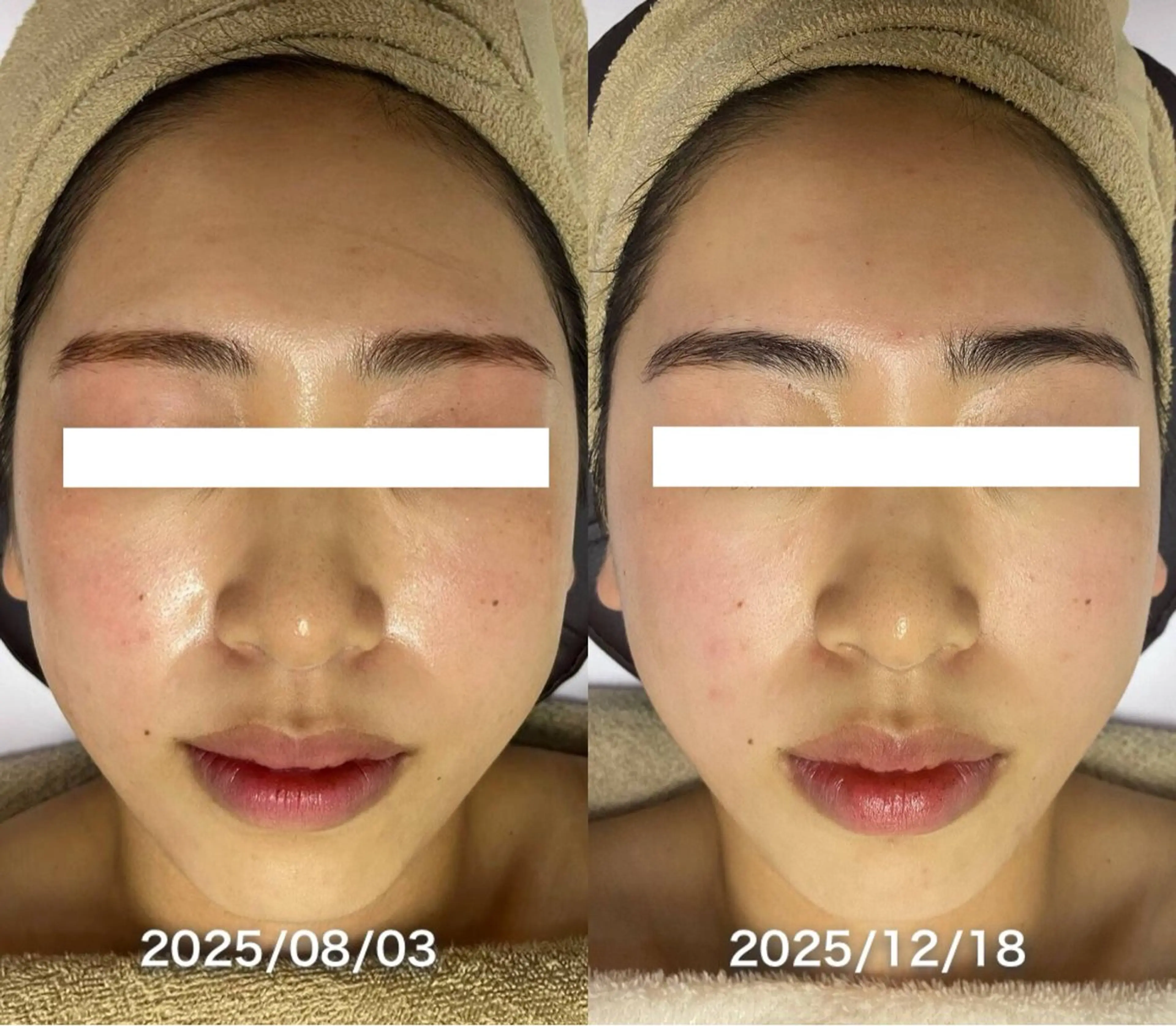 脱毛 韓国美肌/肌質改善 【天神】のエステ・リラクイメージ