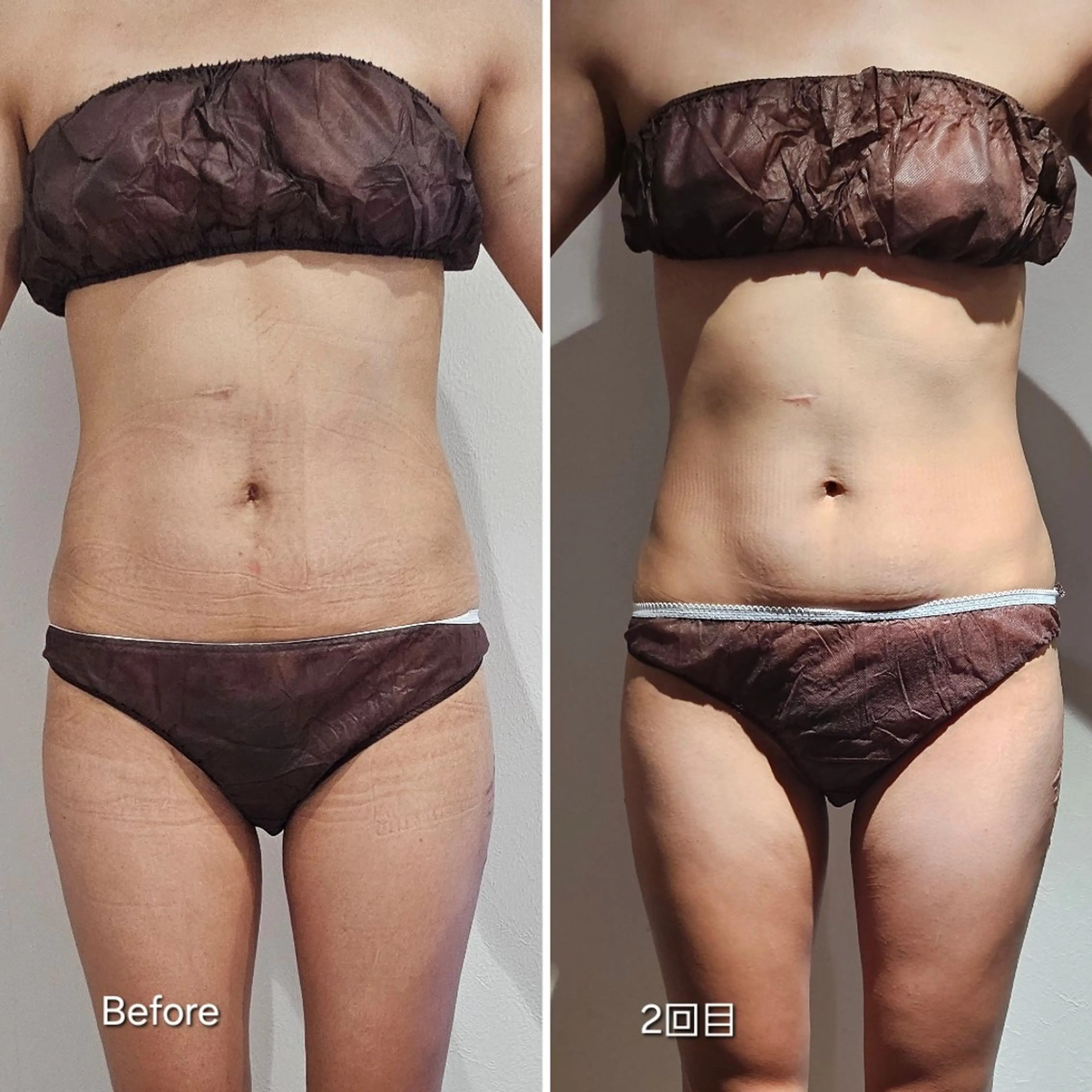 【話題の脂肪痩身マシン】✨LUMIX LIPOCOOL✨3カップの写真