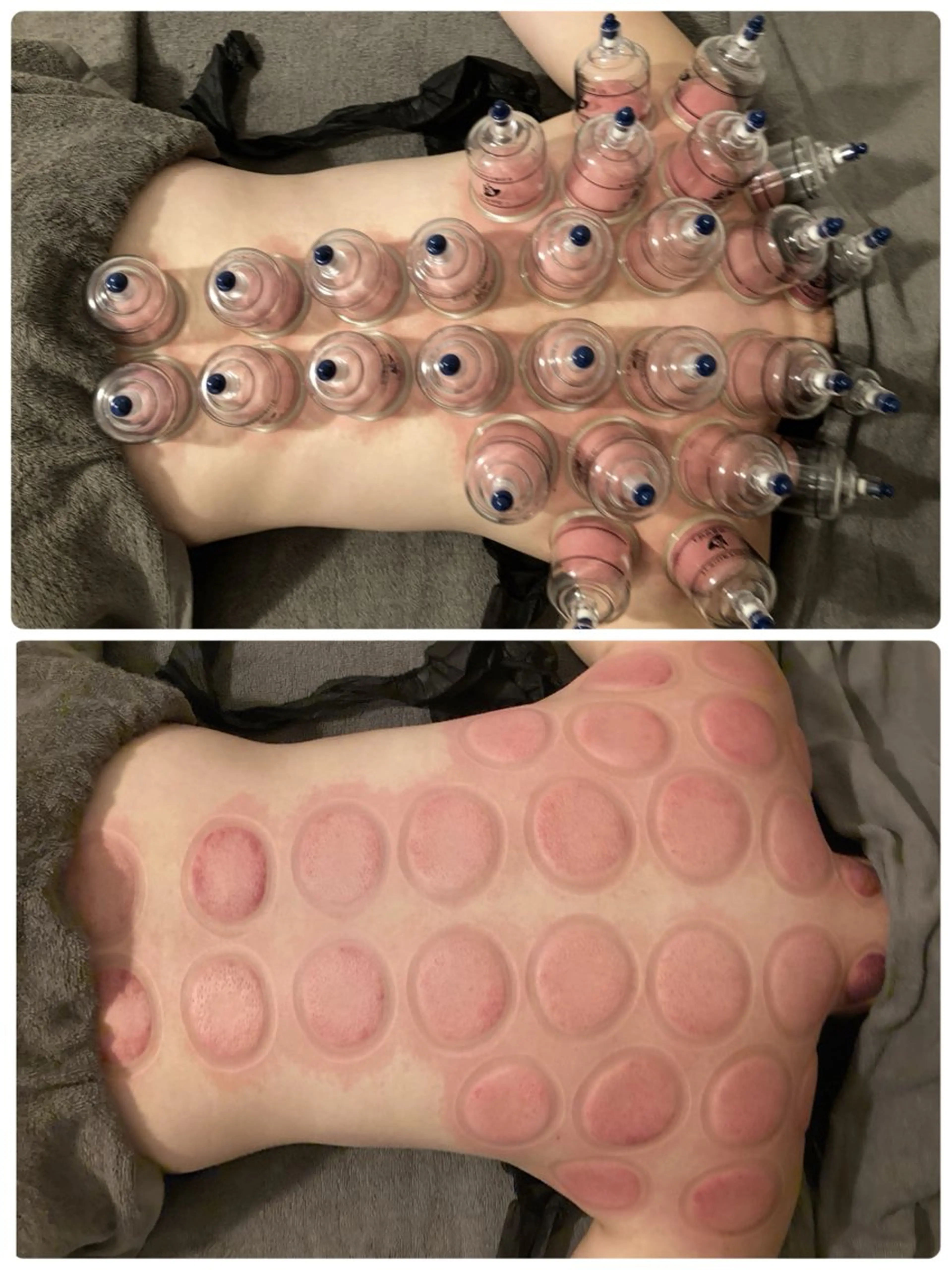 【毒素排出❤️‍🔥体内の老廃物を排出】デトックスカッピング🙆‍♀️🪄🙆‍♂️60min⏳の写真