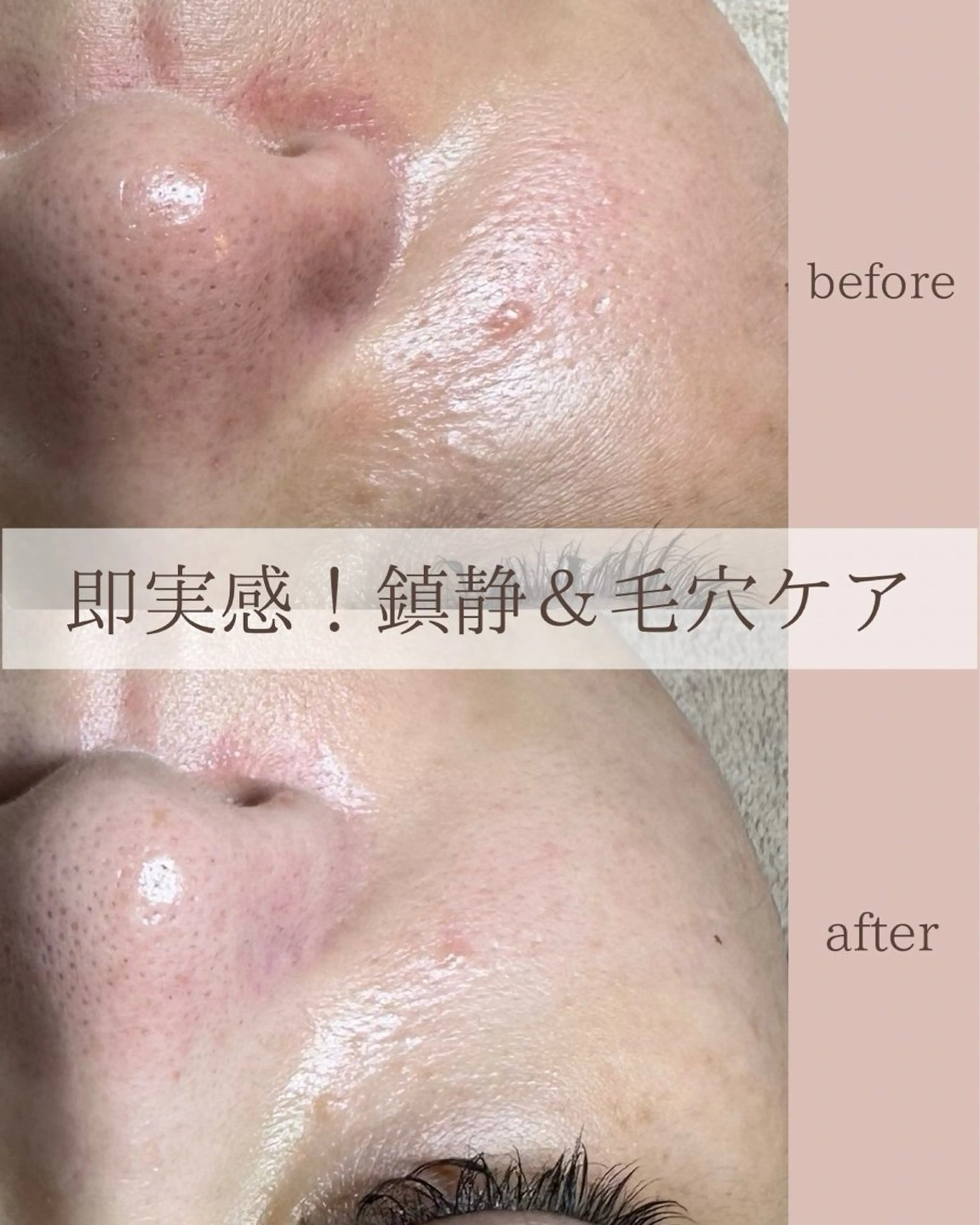 つるんとタマゴ肌✨ピーリング力UP!美肌コースの写真