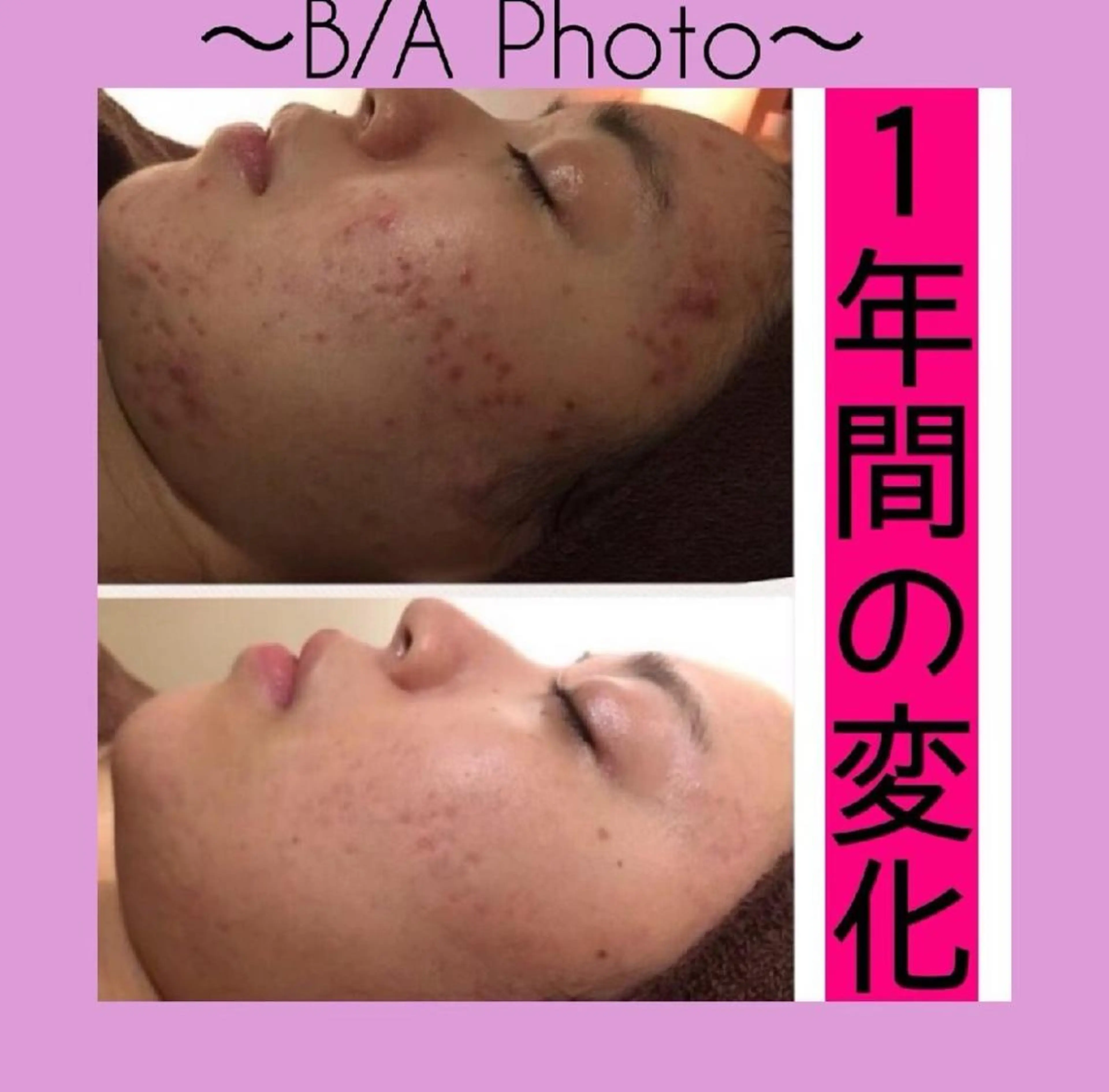 夏までに肌荒れ卒業 するサロン🌻のエステ・リラクイメージ