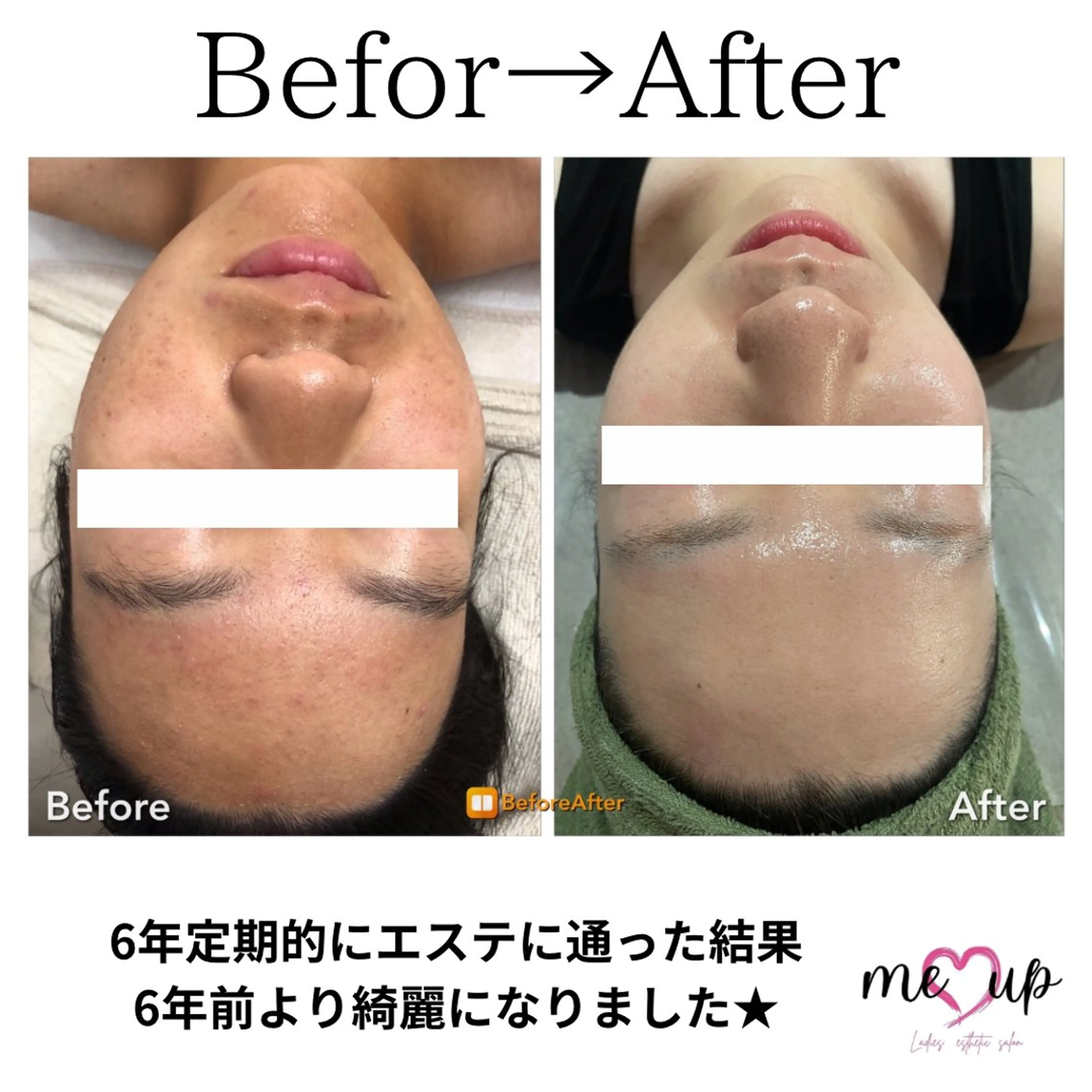 エステ Meupニキビ専門店 背中/ハーブ/肌管理のその他イメージ