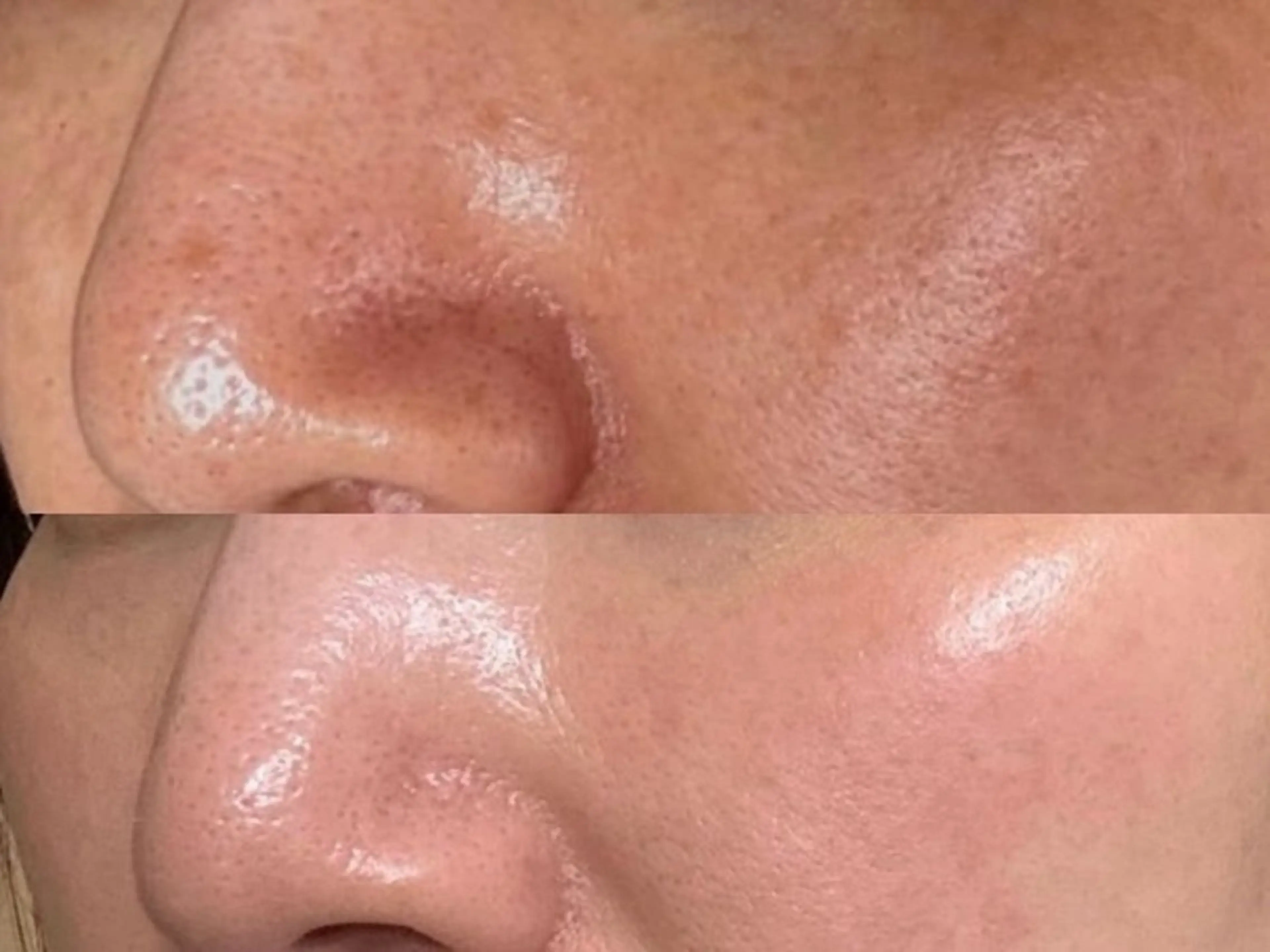 【本格シミ改善】剥離ハーブピーリング＆顔リンパマッサージ¥23000→の写真