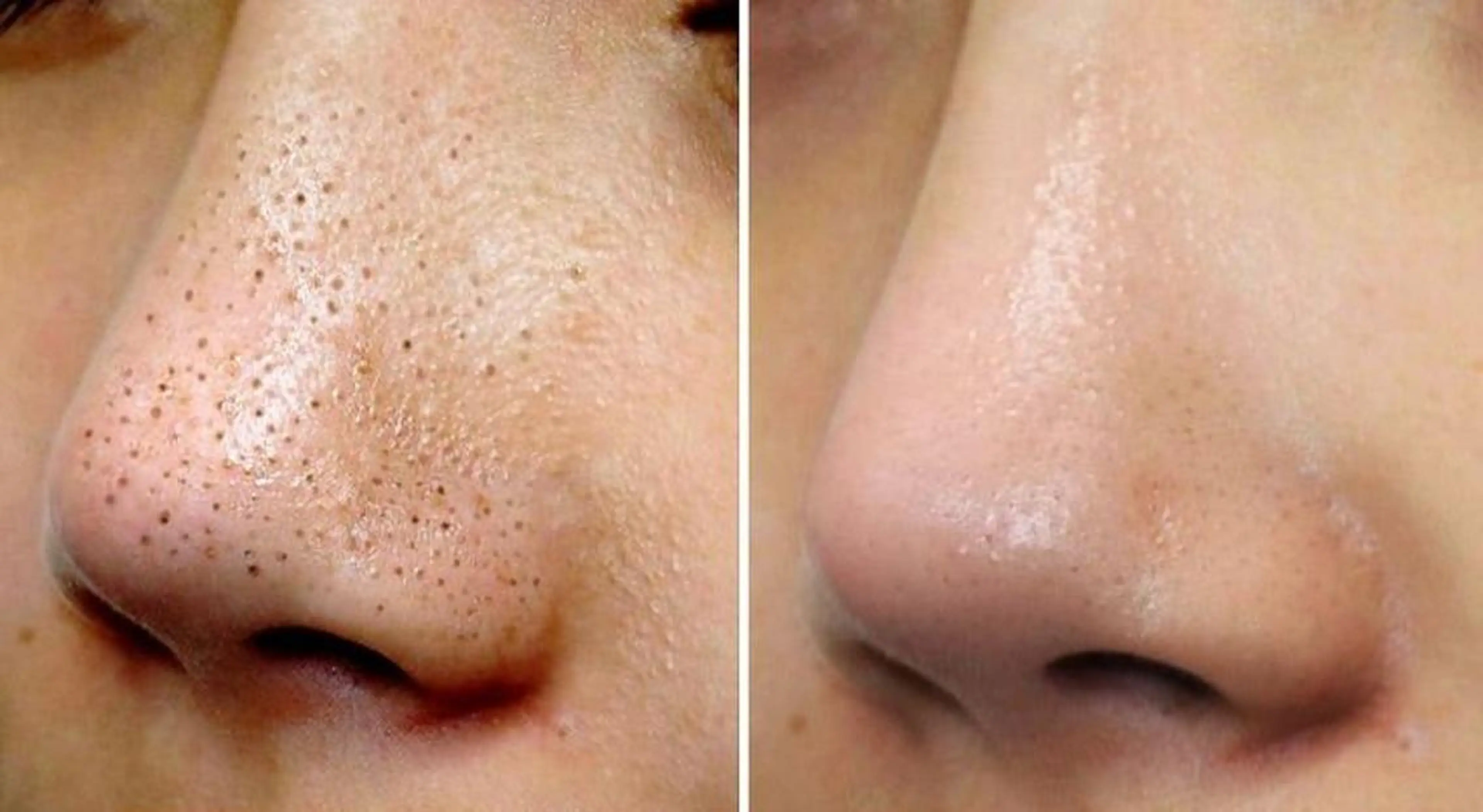 ◆毛穴掃除６０分！！！顔ダニ大掃除♪リフレッシュして新年を迎えましょう。の写真