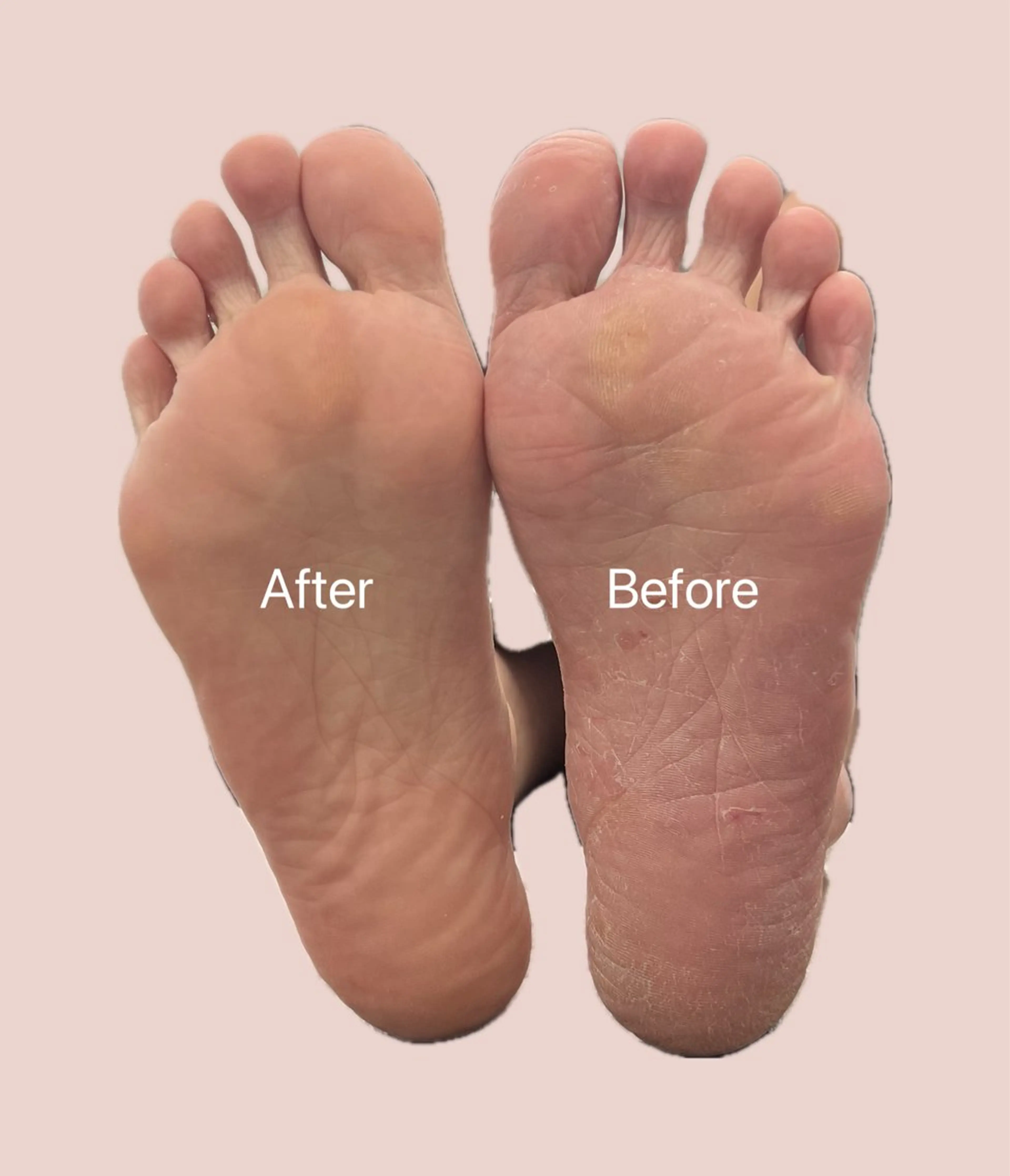 フット角質ケア冬眠コース🐿‪🤎 【ネイルオフ＋¥1000】モニター価格✨️の写真