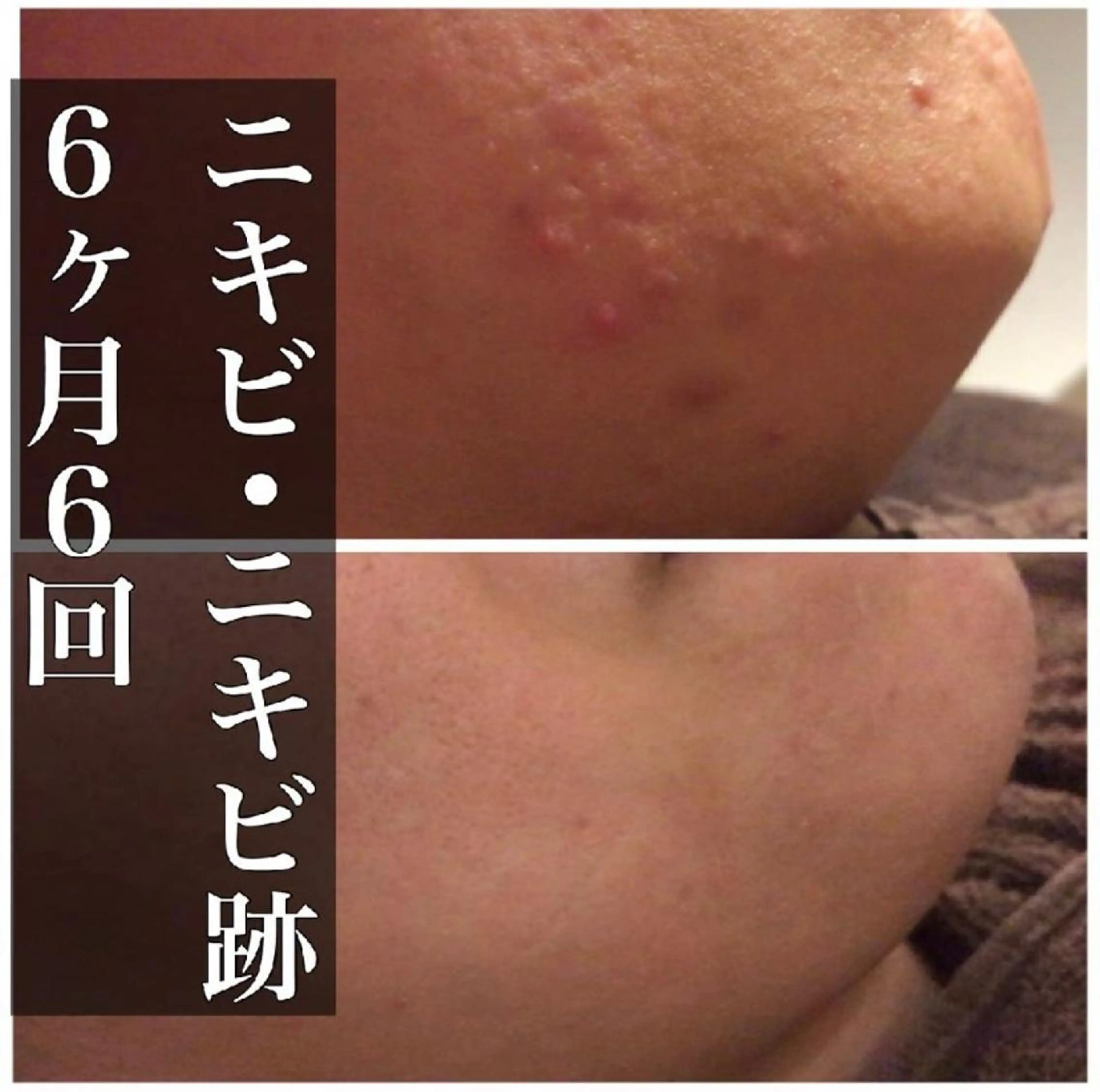 セミロング カラー パーマ ヘアアレンジ メンズ キッズ ネイル マツエク・マツパ アイブロウ 夏までに肌荒れ卒業 するサロン🌻のエステ・リラクイメージ