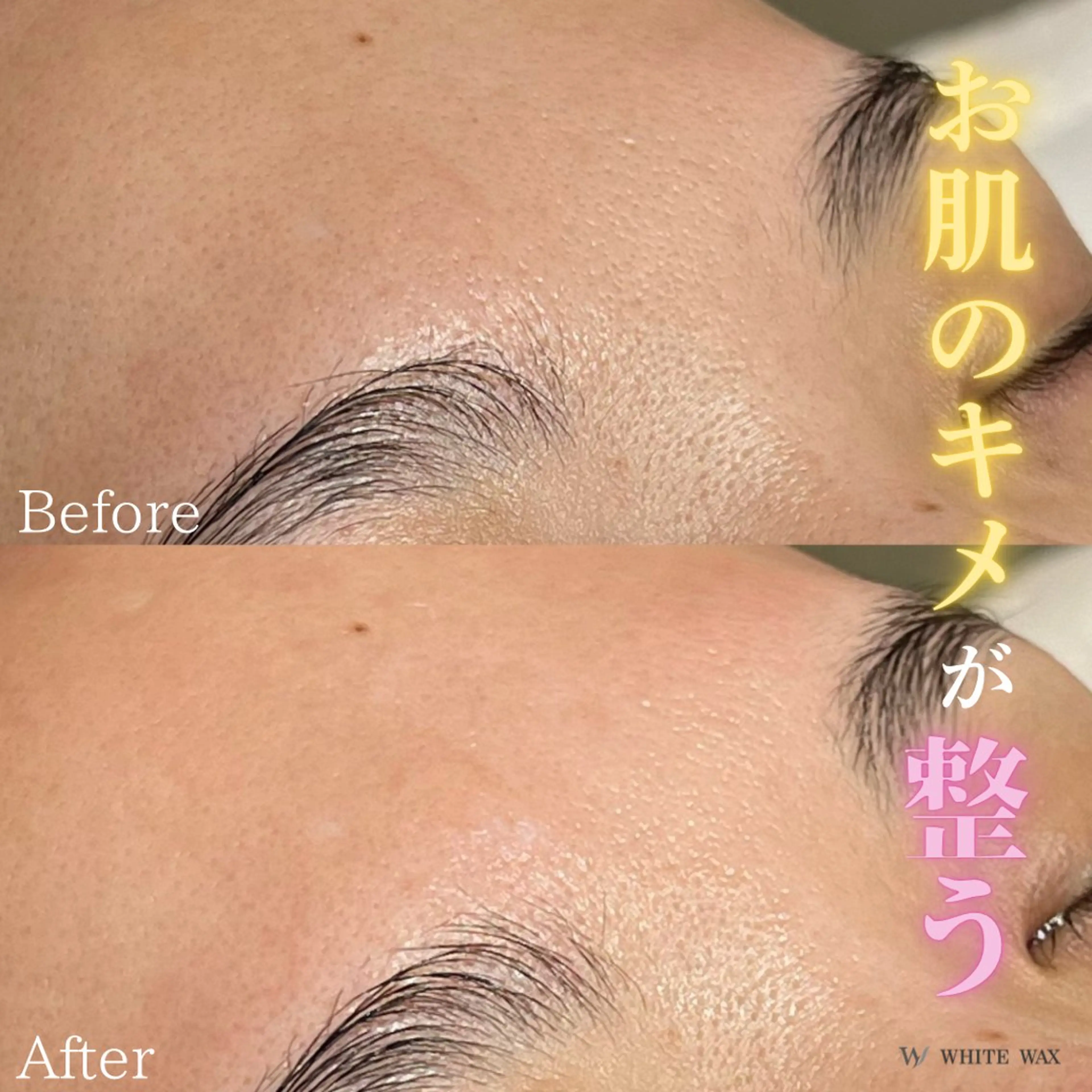 全顔フェイシャルワックス➕生プラセンタ美容液導入✨【憧れの水光ツヤ肌に🧏🏻♀️🩵】の写真