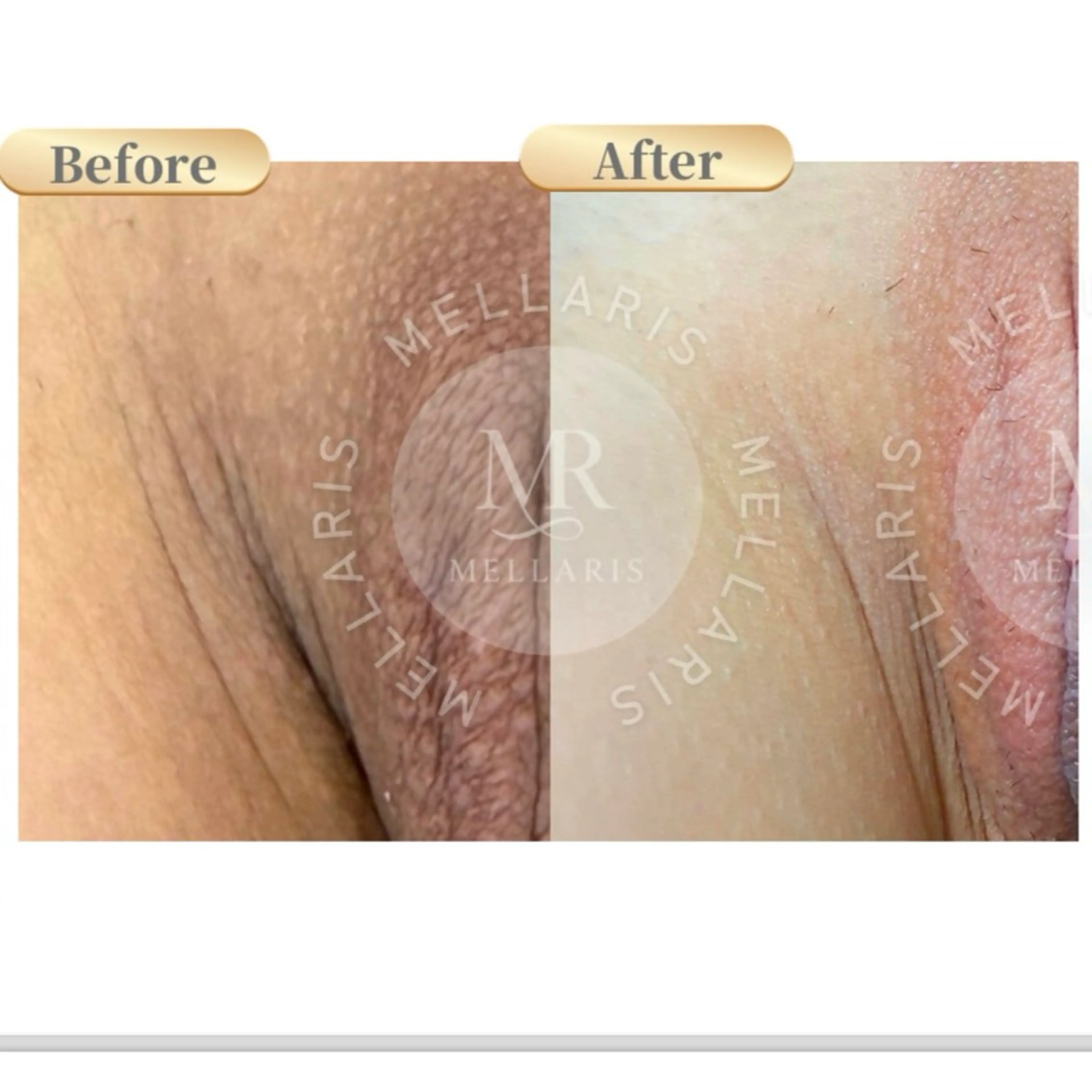 【1/17​〜​】デリケートゾーン黒ずみ除去🍑アフターケアクリーム付！初の国産メラニンケア✨ルメラ・ローマピンクの次世代版の写真