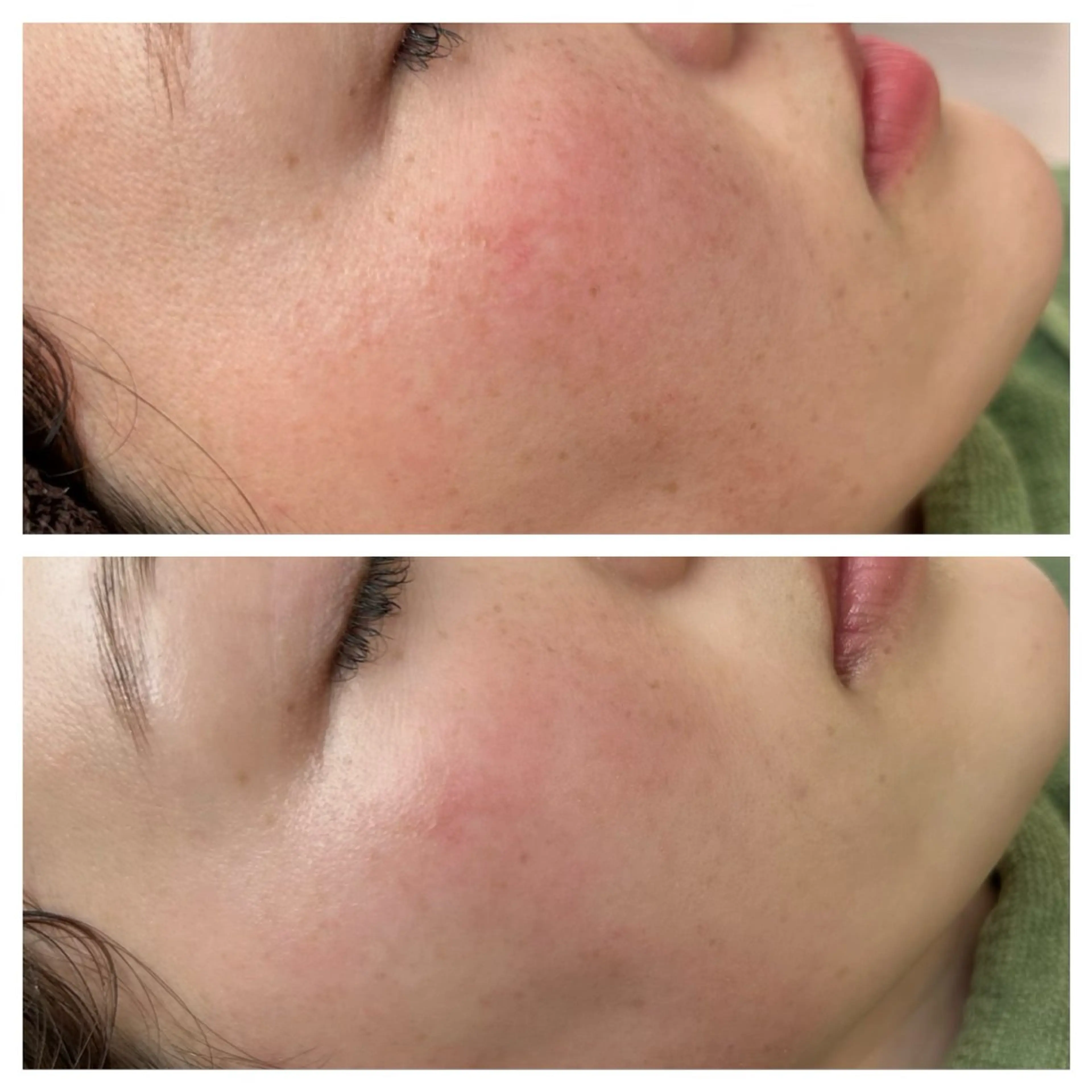 レベルアップ式のトリートメント🐝　　　　　　　　　マイクロニードルピーリング🪡の写真