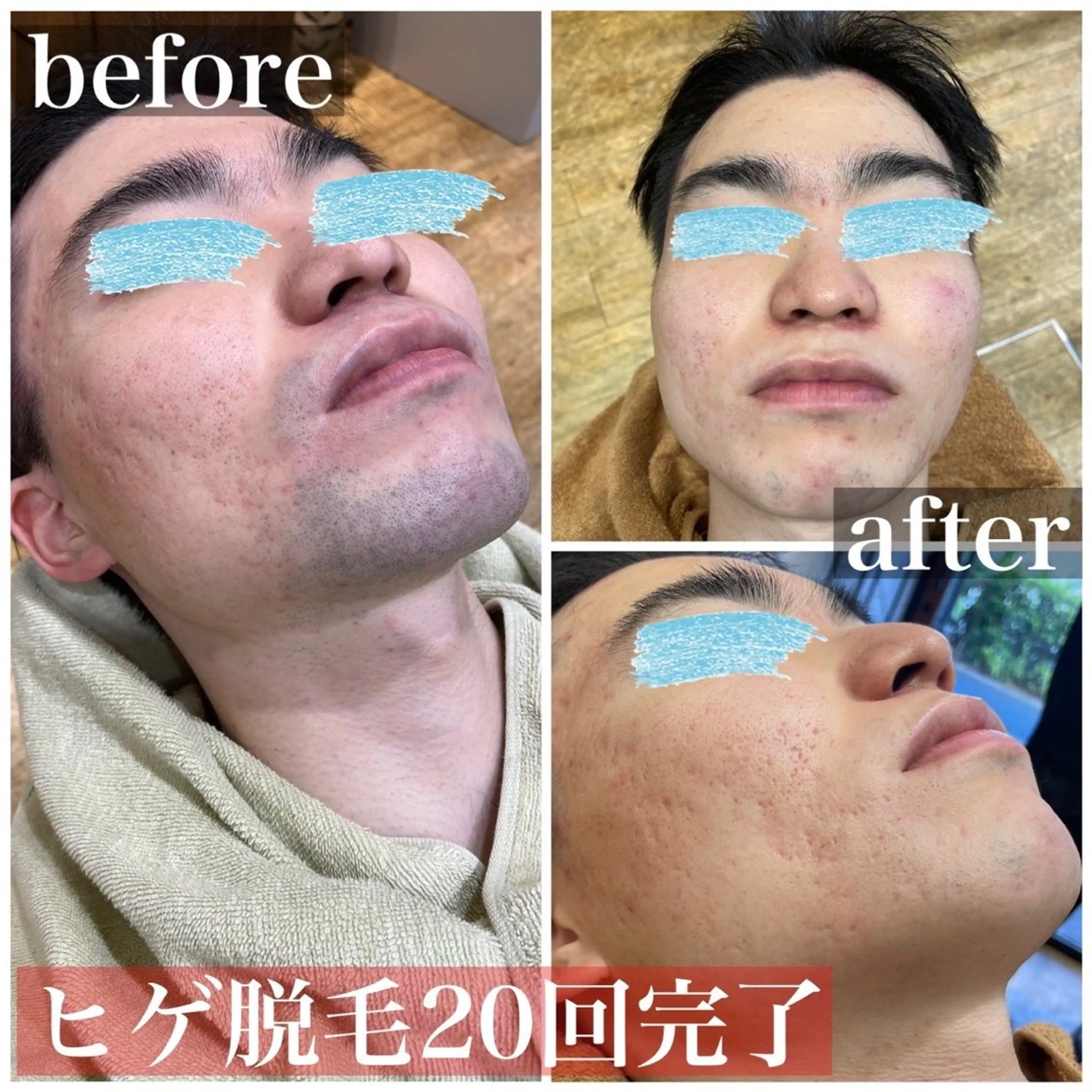 メンズ 脱毛 HAIRS YOSHIOKA所属・ヘアーズヨシオカ MENSヒゲ脱毛のエステ・リラクイメージ