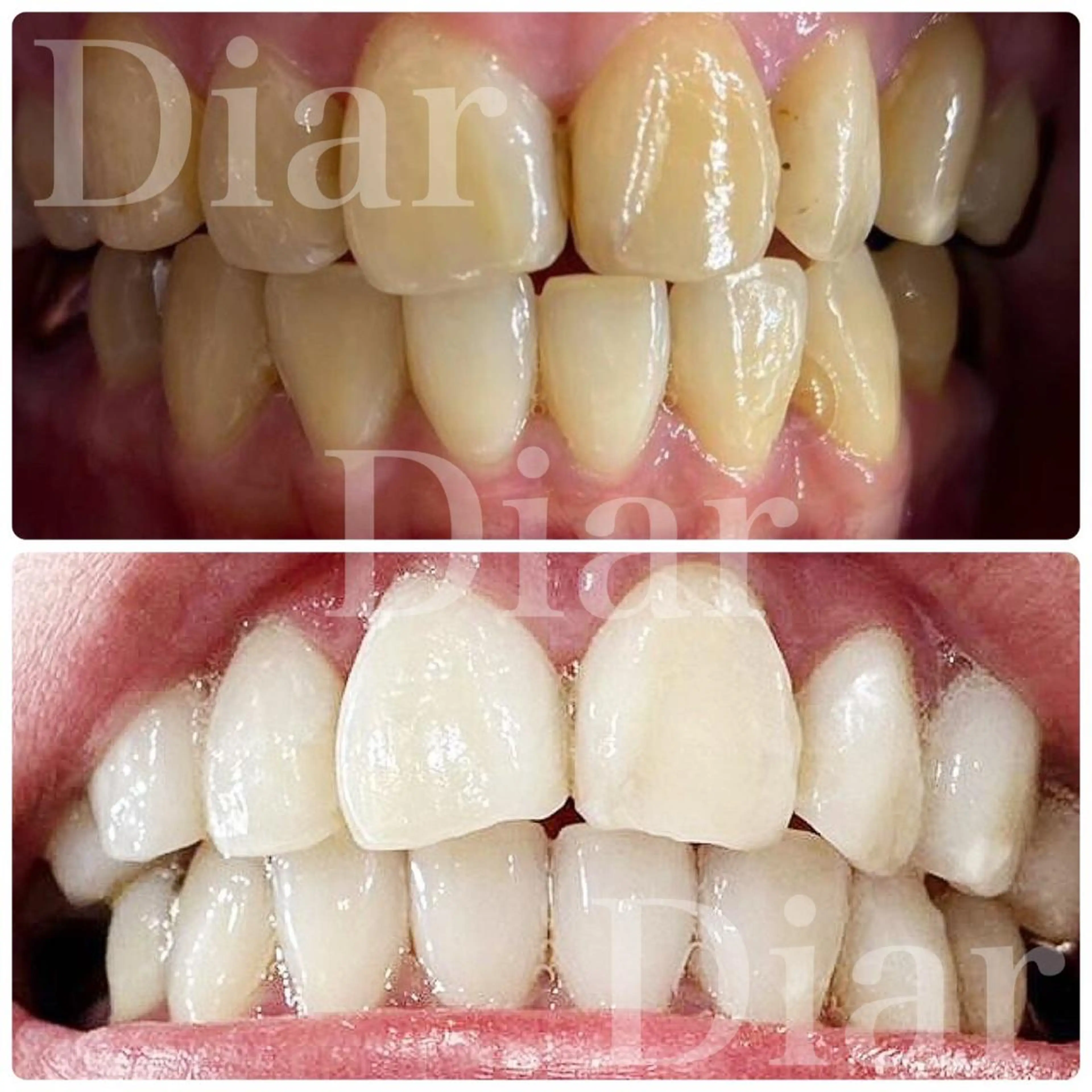 🦷セルフホワイトニング🦷（2回照射）の写真