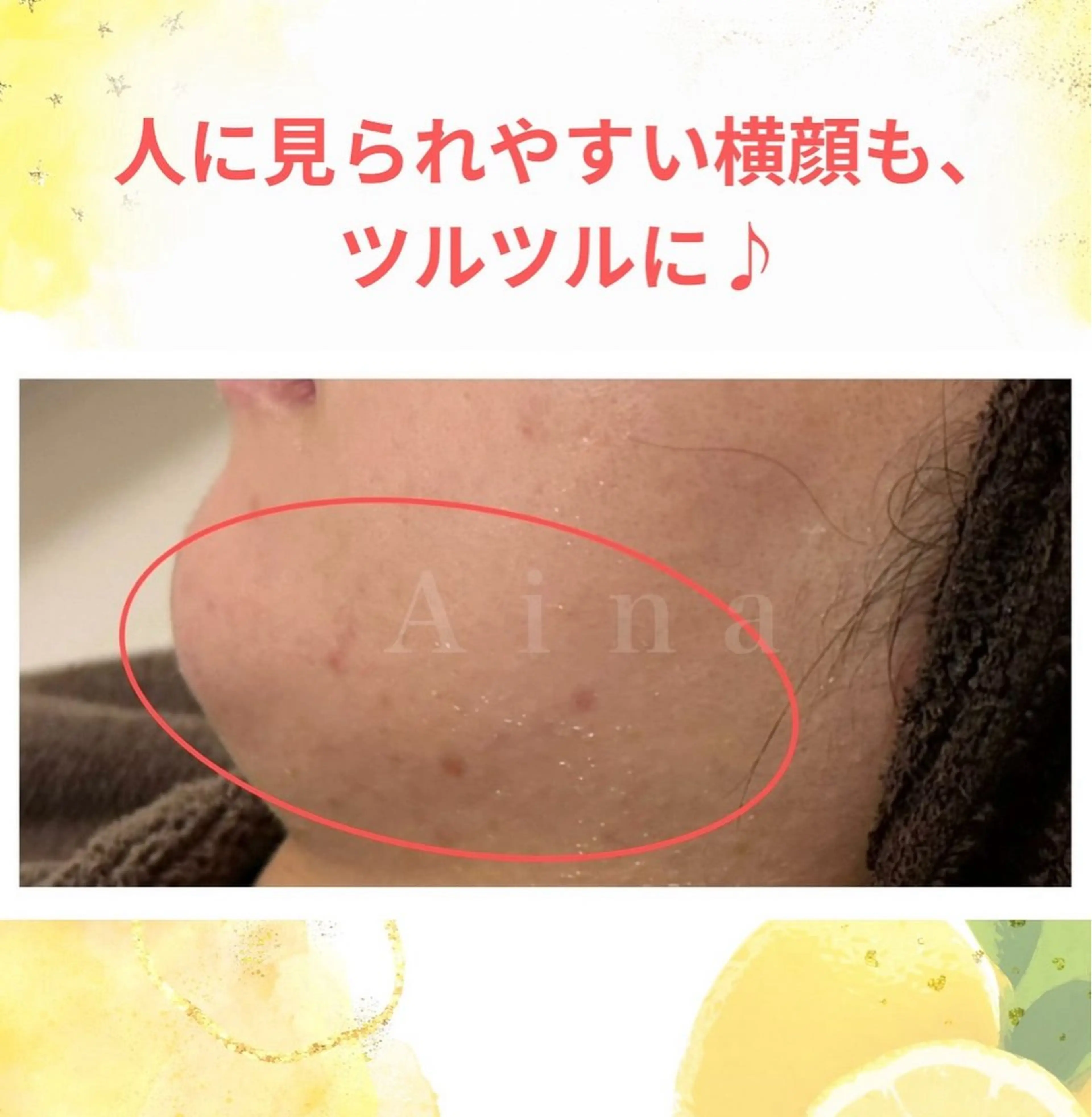 エステ リラク ニキビ跡専門サロン Ａｉｎａのエステ・リラクイメージ