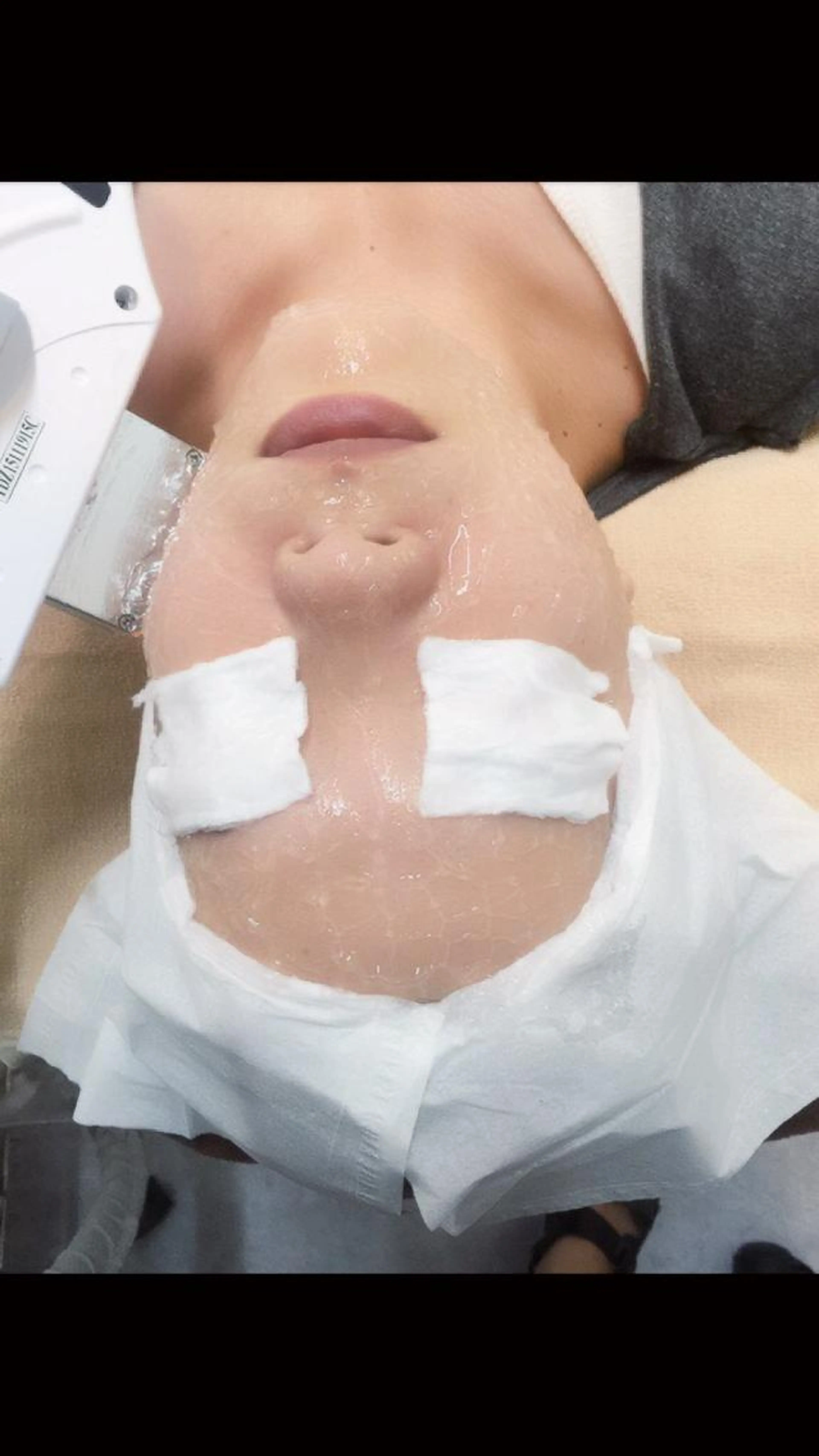 顔だけ脱毛❗️ご新規様限定３回コース🪒の写真