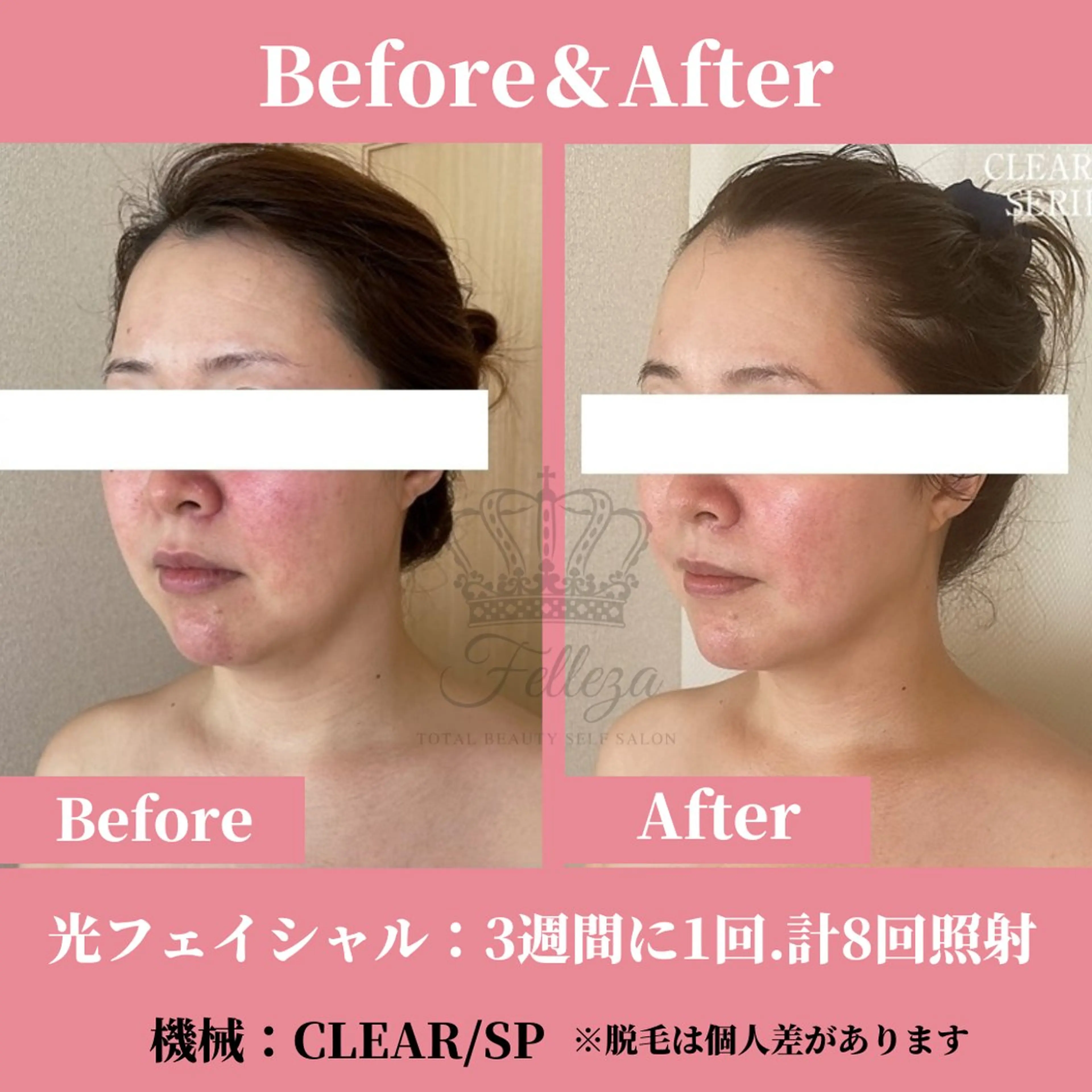 メンズ 有人型セルフサロン 脱毛／痩身／美顔のその他イメージ