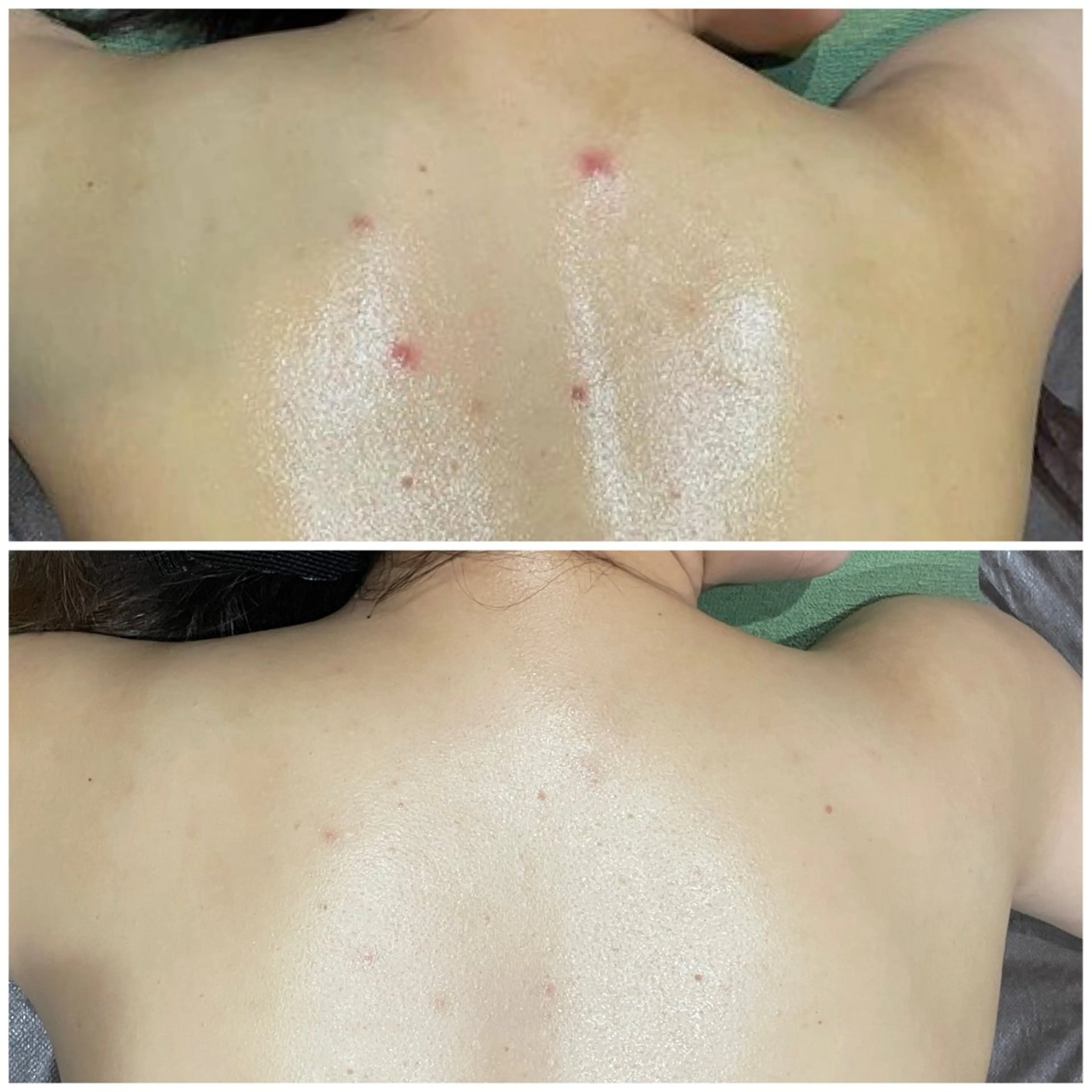 《背中ニキビに◎》初回 ハーブピーリング🌿‬ ܸソフト(背中上部or下部)の写真