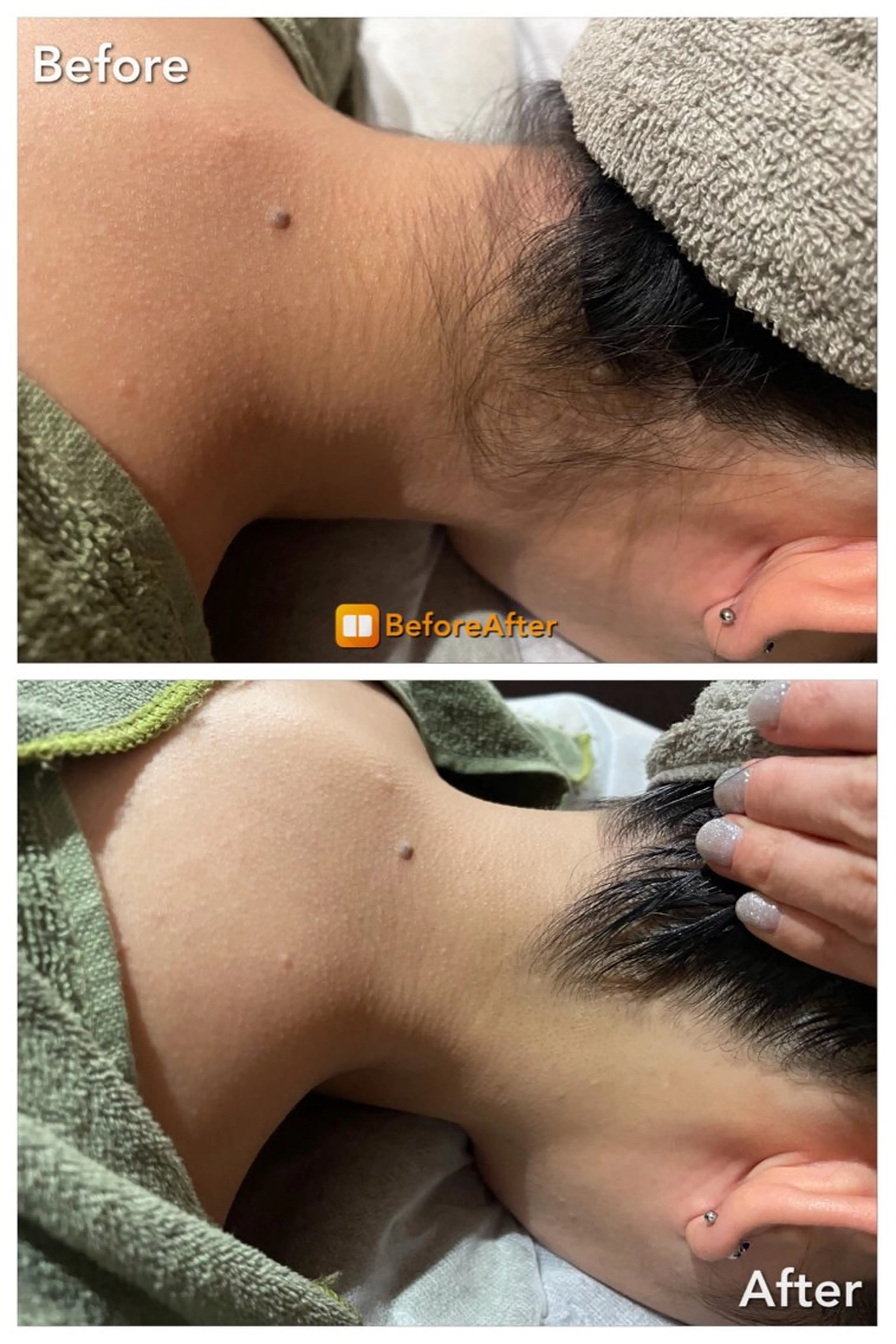 Meupニキビ専門店 背中/ハーブ/肌管理のその他イメージ