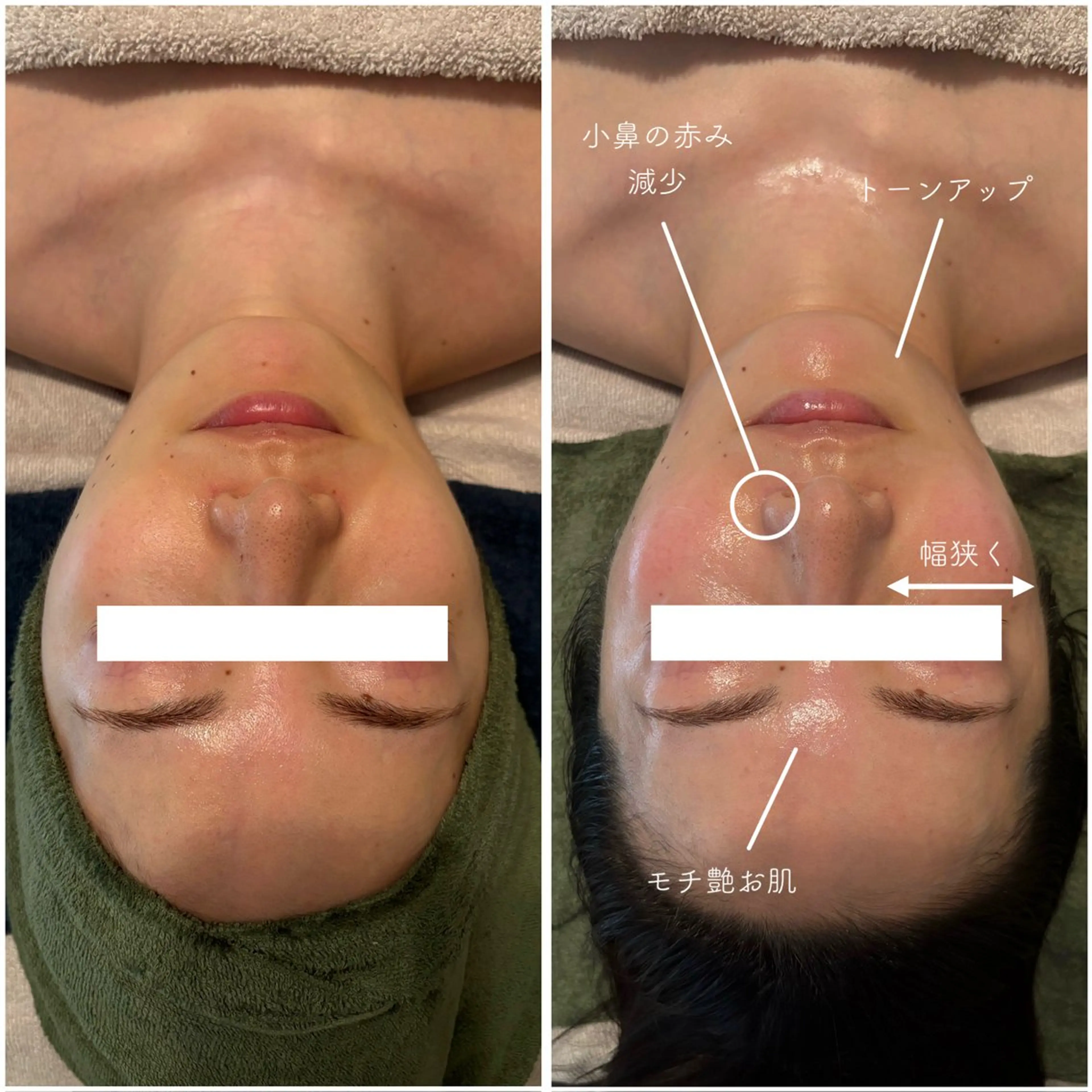 瞬時に潤い&リフトUPを叶える★エアバリフェイシャルの写真