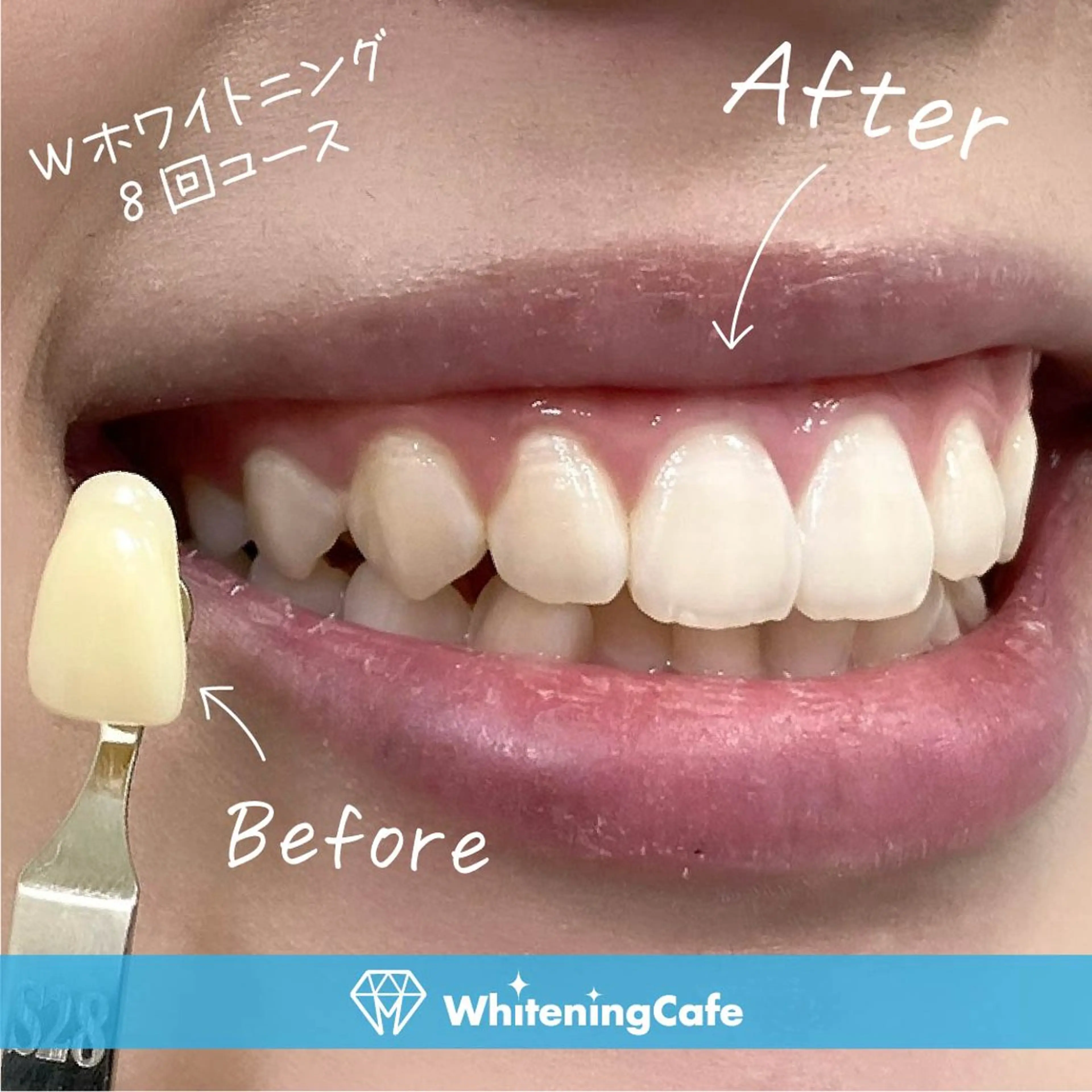 【圧倒的人気/セルフホワイトニング回数券】8回コース+1回セルフホワイトニングプレゼントの写真