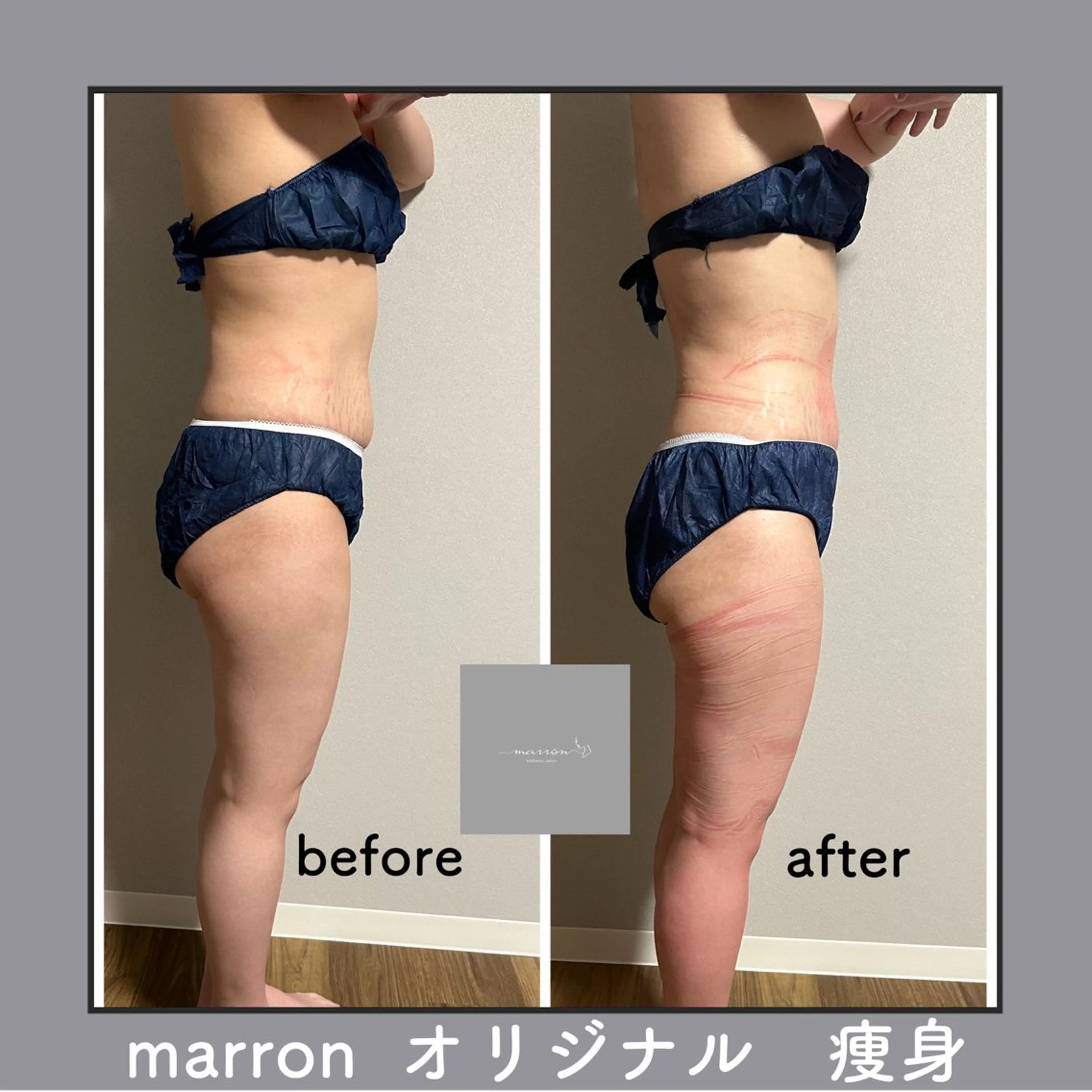 marron所属・痩身ハイパーナイフ ララピールリアボーテのエステ・リラクイメージ