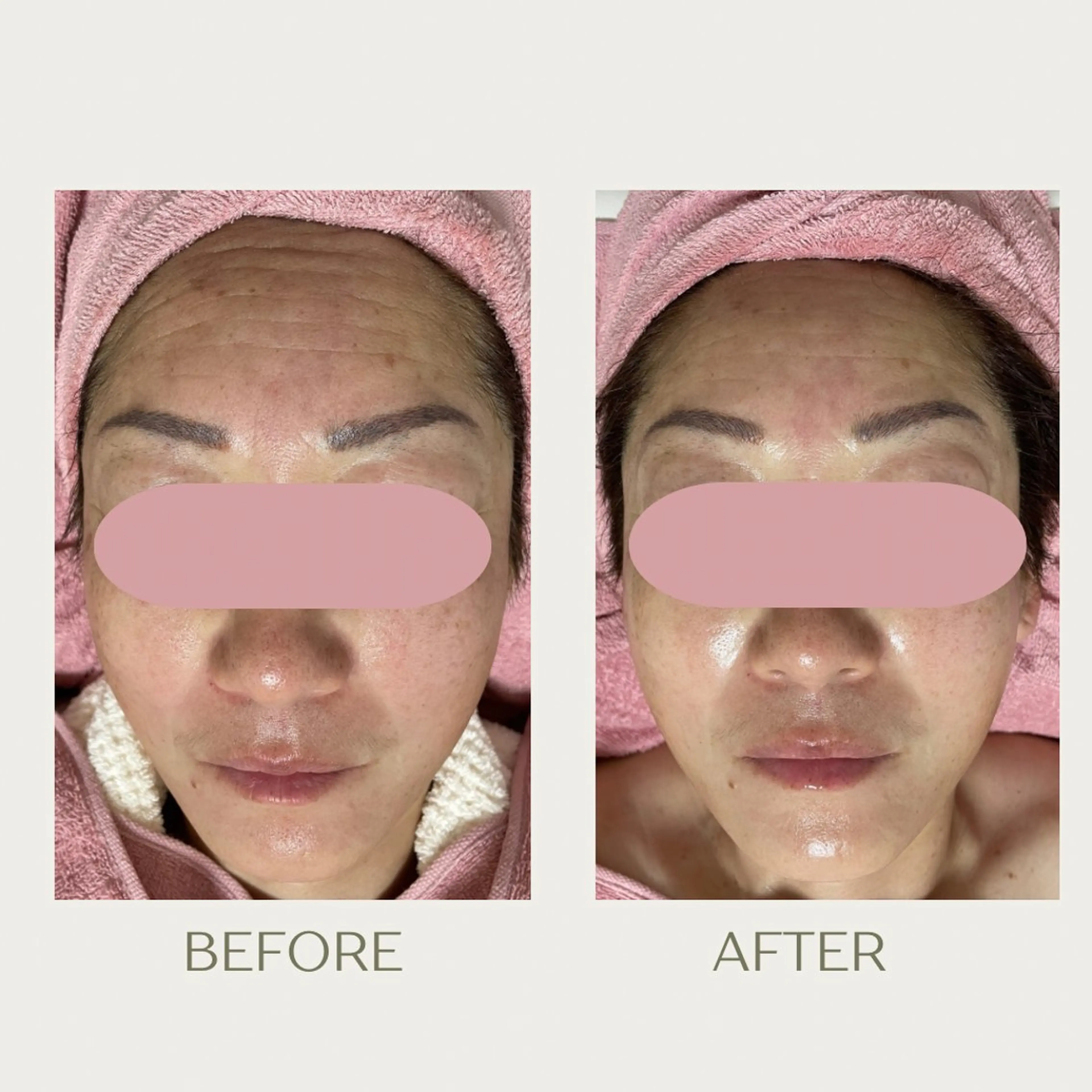 エステ ピーリングケア 🤍moekoのエステ・リラクイメージ