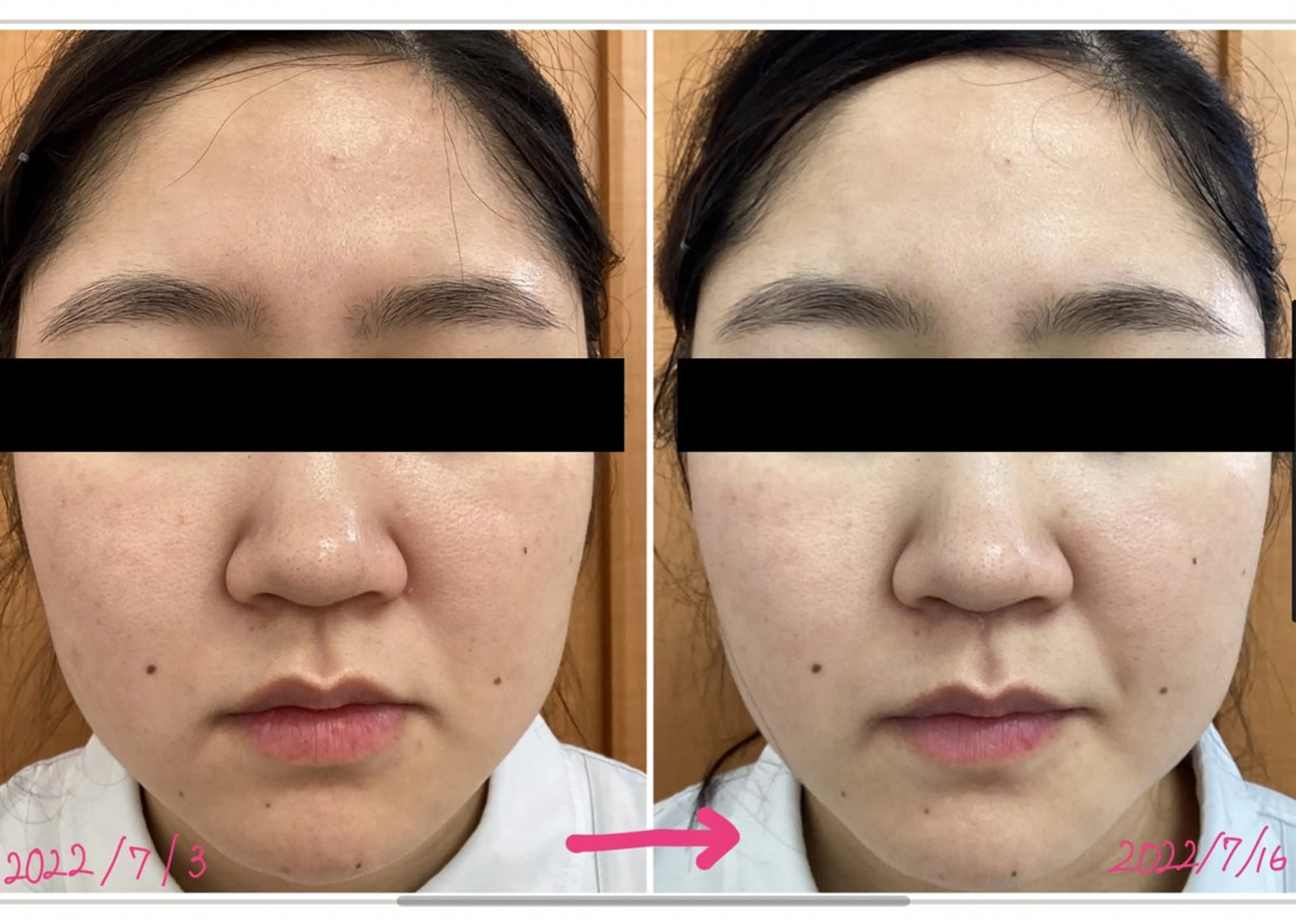 潤い美白フェイシャル3回プログラムの写真