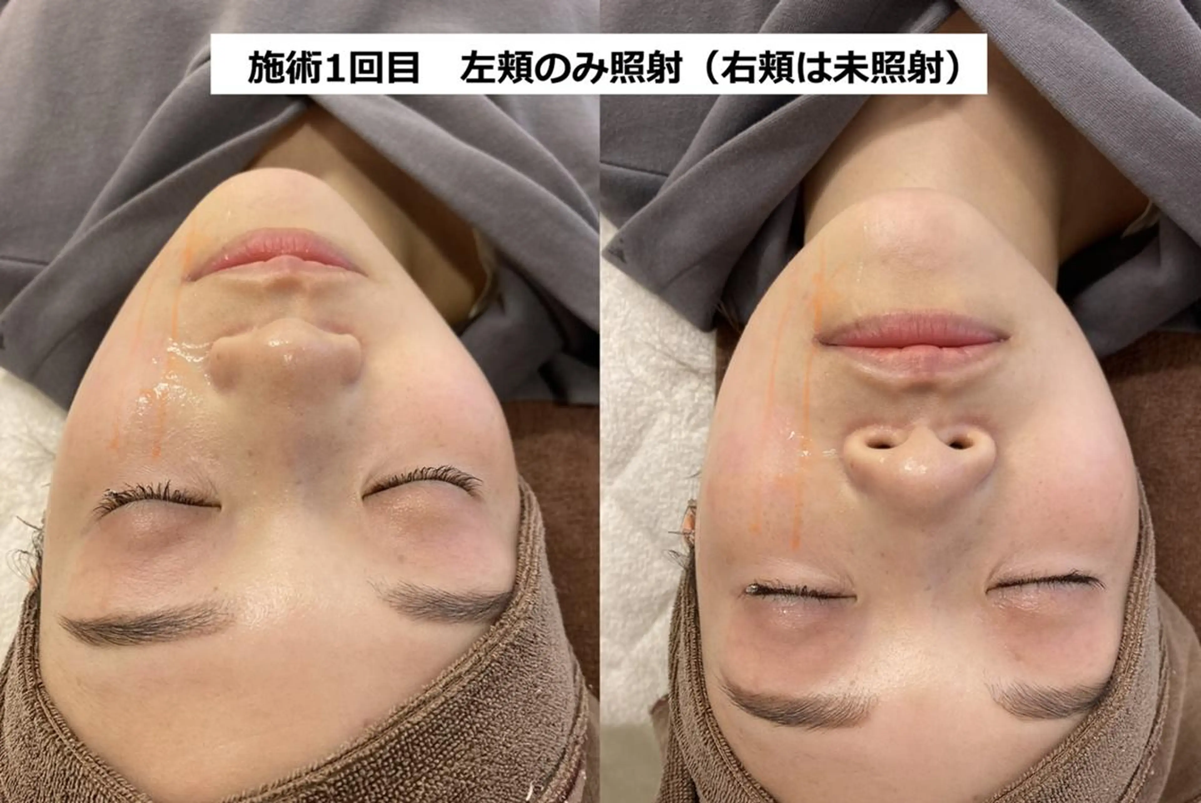 エステ 顔脱毛＆毛穴＆ニキビ 優良№1♪ヒロコ♪のエステ・リラクイメージ