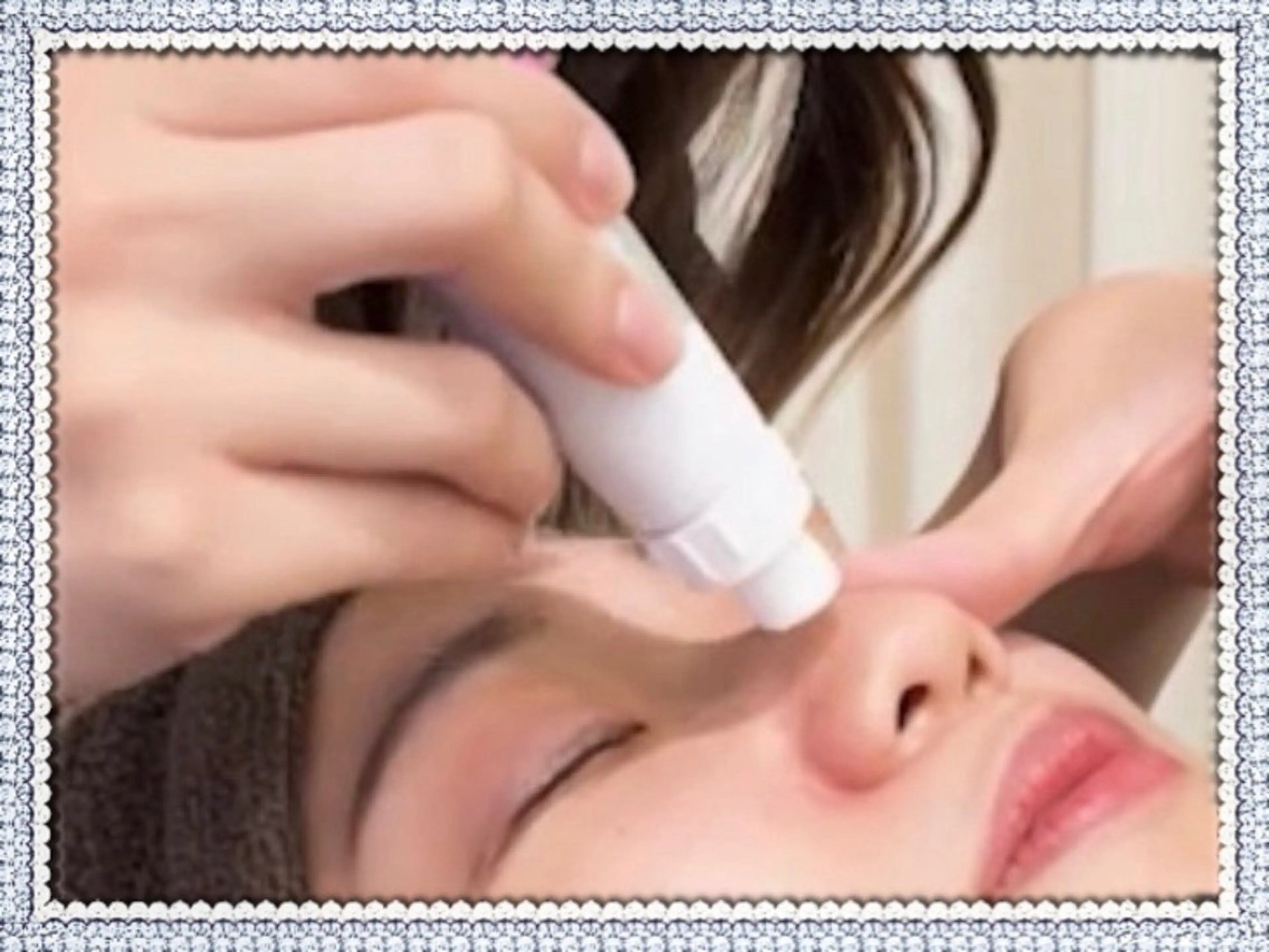 ★黒ズミ角栓ごっそり★プラズマ&ハイドラピーリングの写真