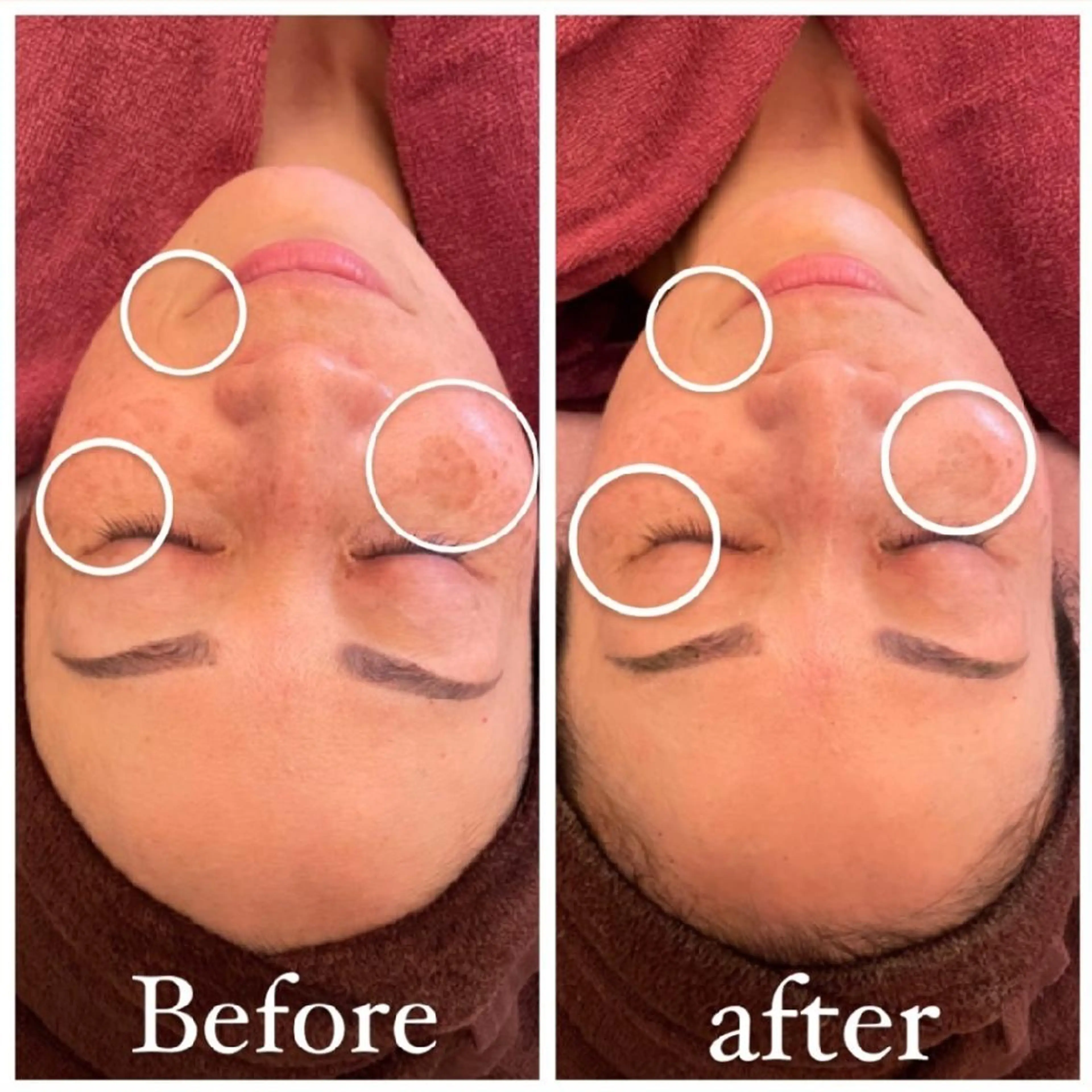 陶肌トリートメント　　ハーブピーリングの写真