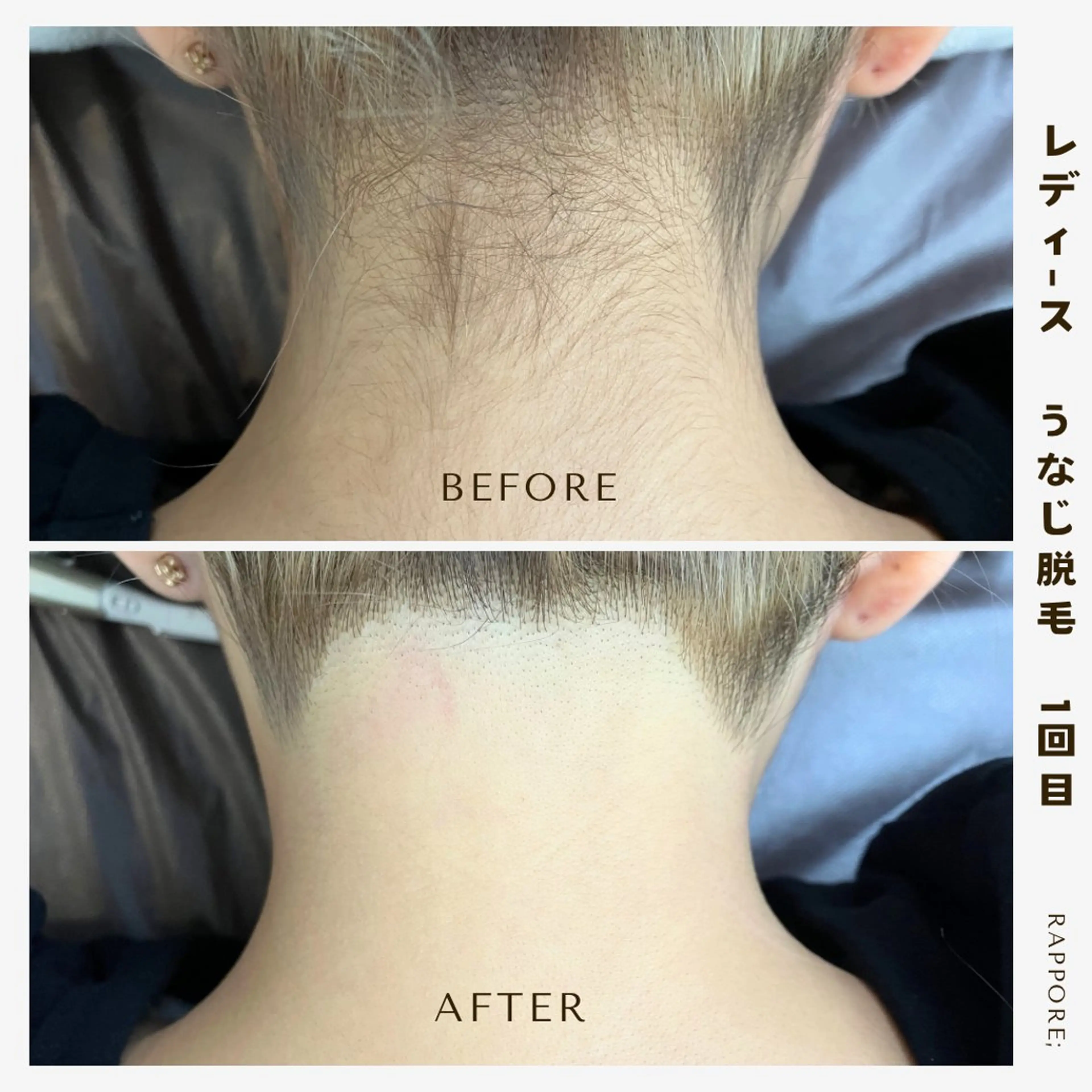 顔➕うなじ脱毛セット🍄（シェービング付き）の写真