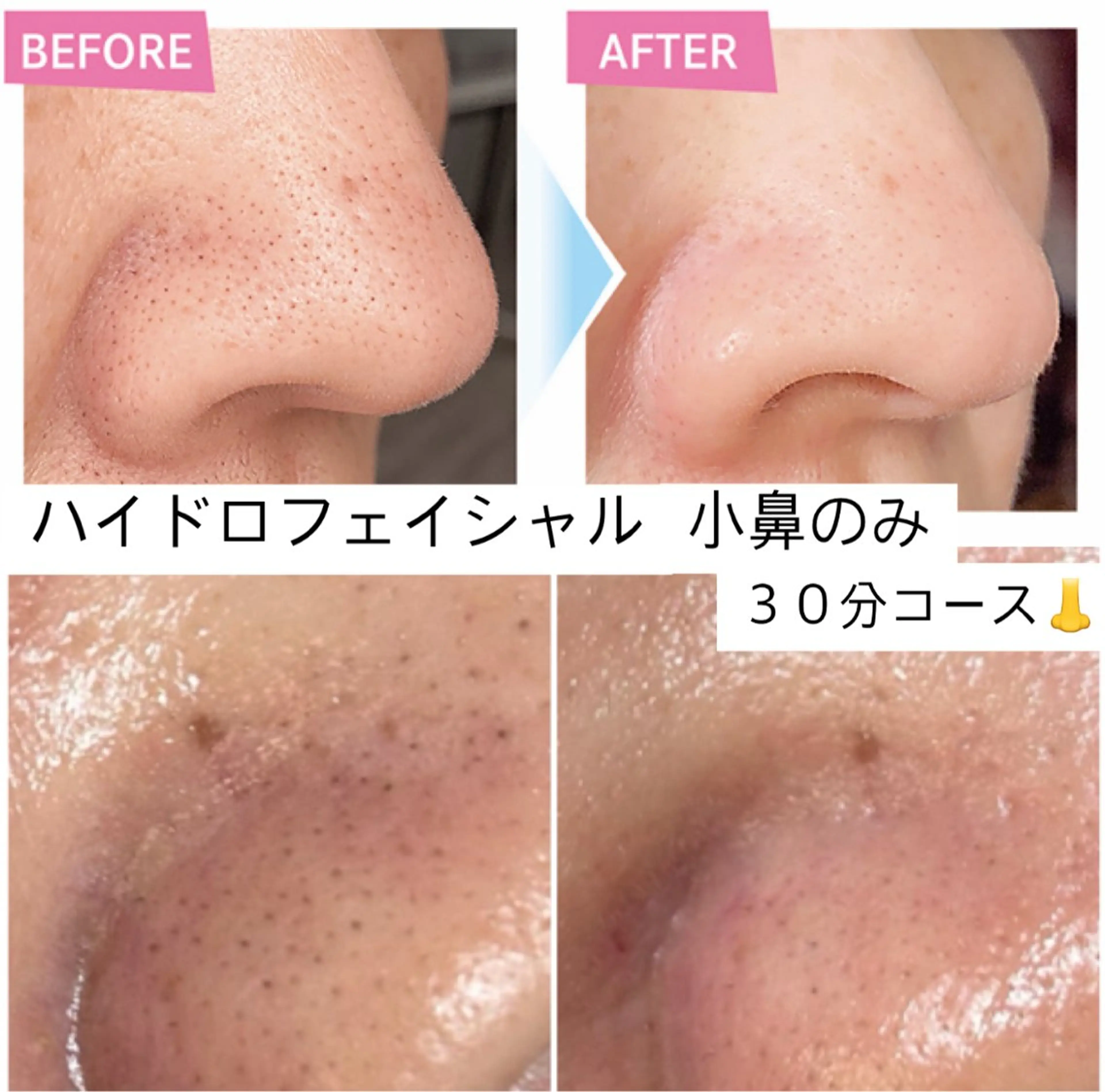 今だけキャンペーンハイドロフェイシャル小鼻のみのポイントケアコース♪の写真