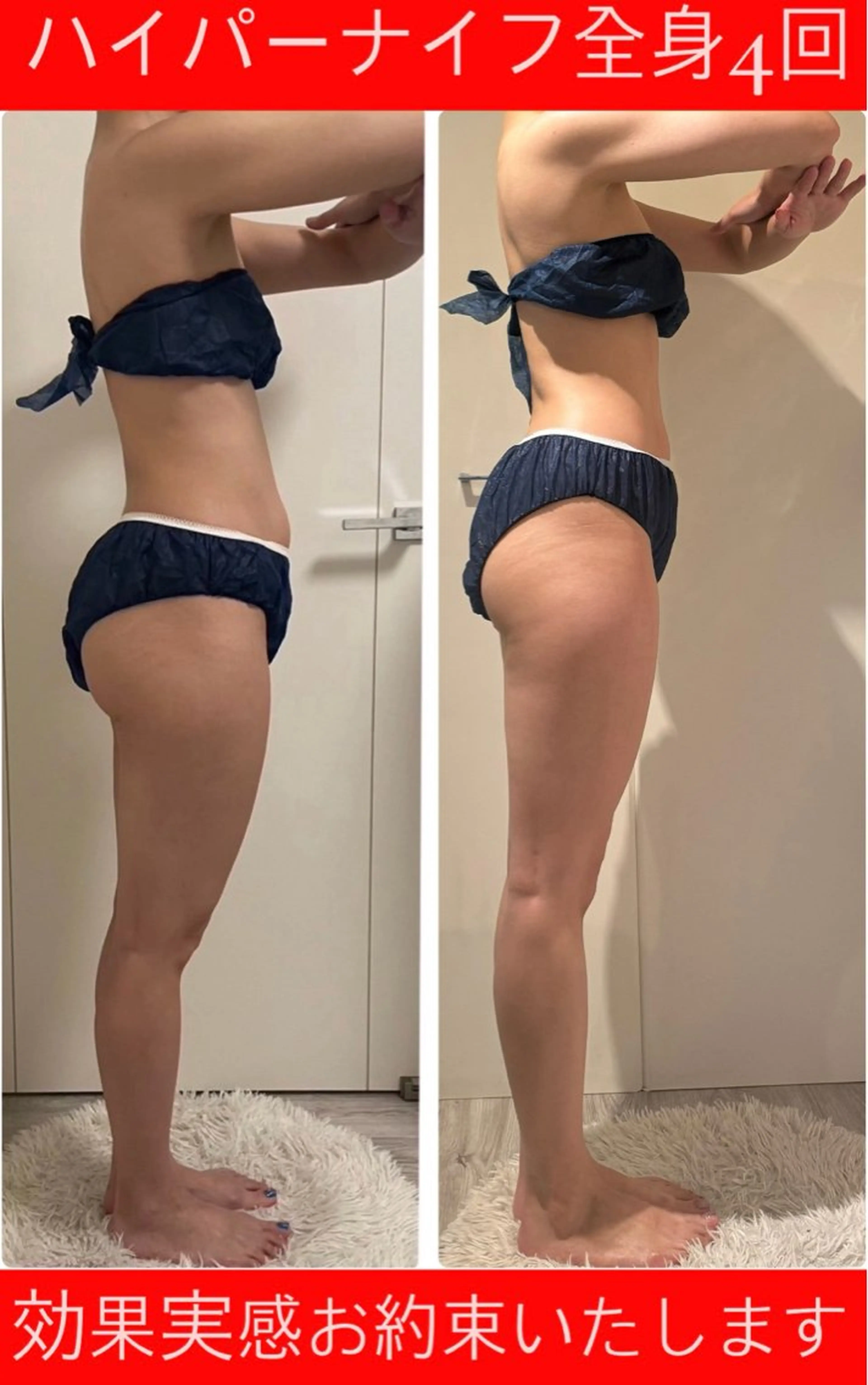 絶対痩せたい方はこちら★最新痩身マシンを驚きの価格でご体験！！👙上半身or下半身🦵全身のご依頼も可◎の写真