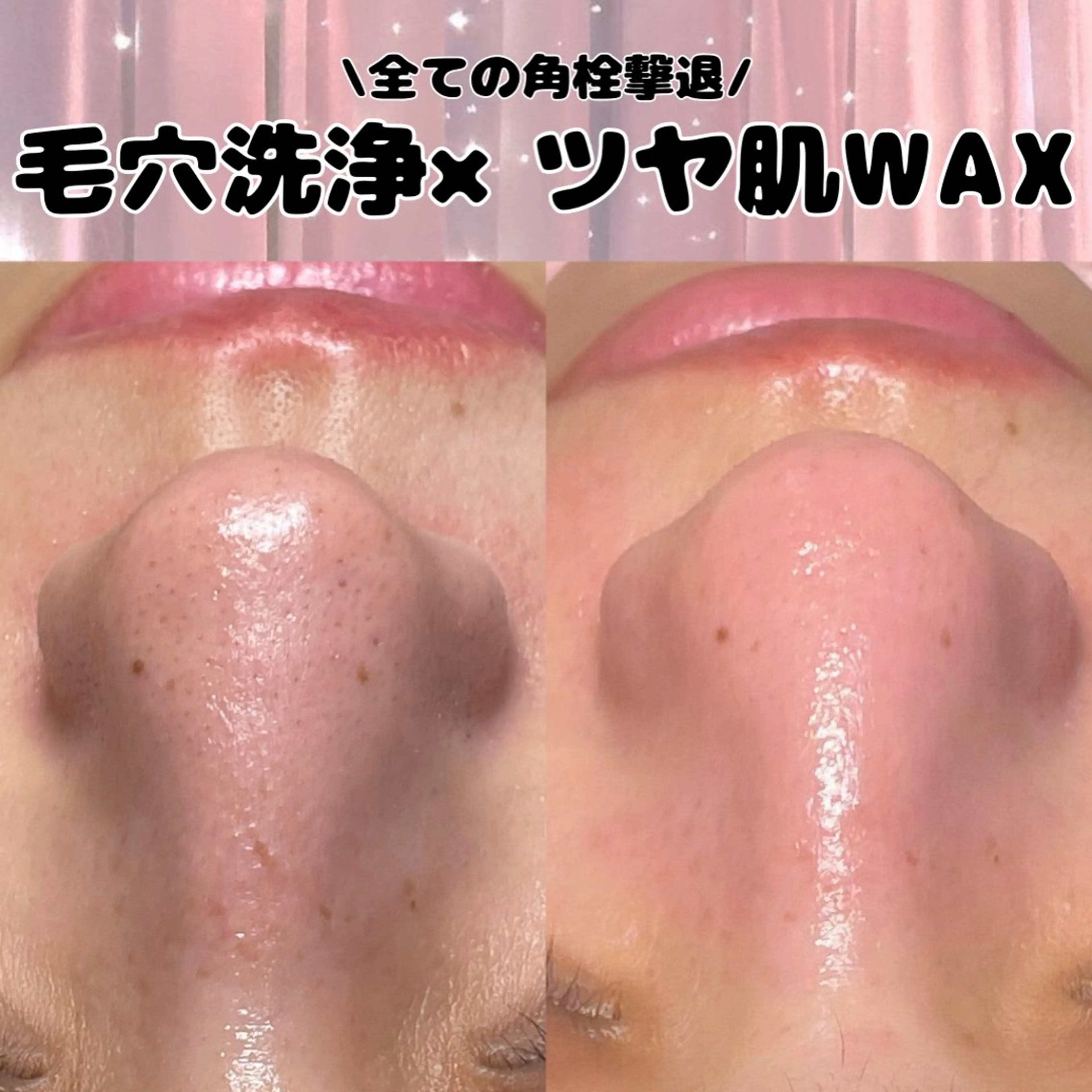 鼻の毛穴にお悩みの方💭毛穴洗浄×ツヤ肌WAX【鼻のみ】✨の写真