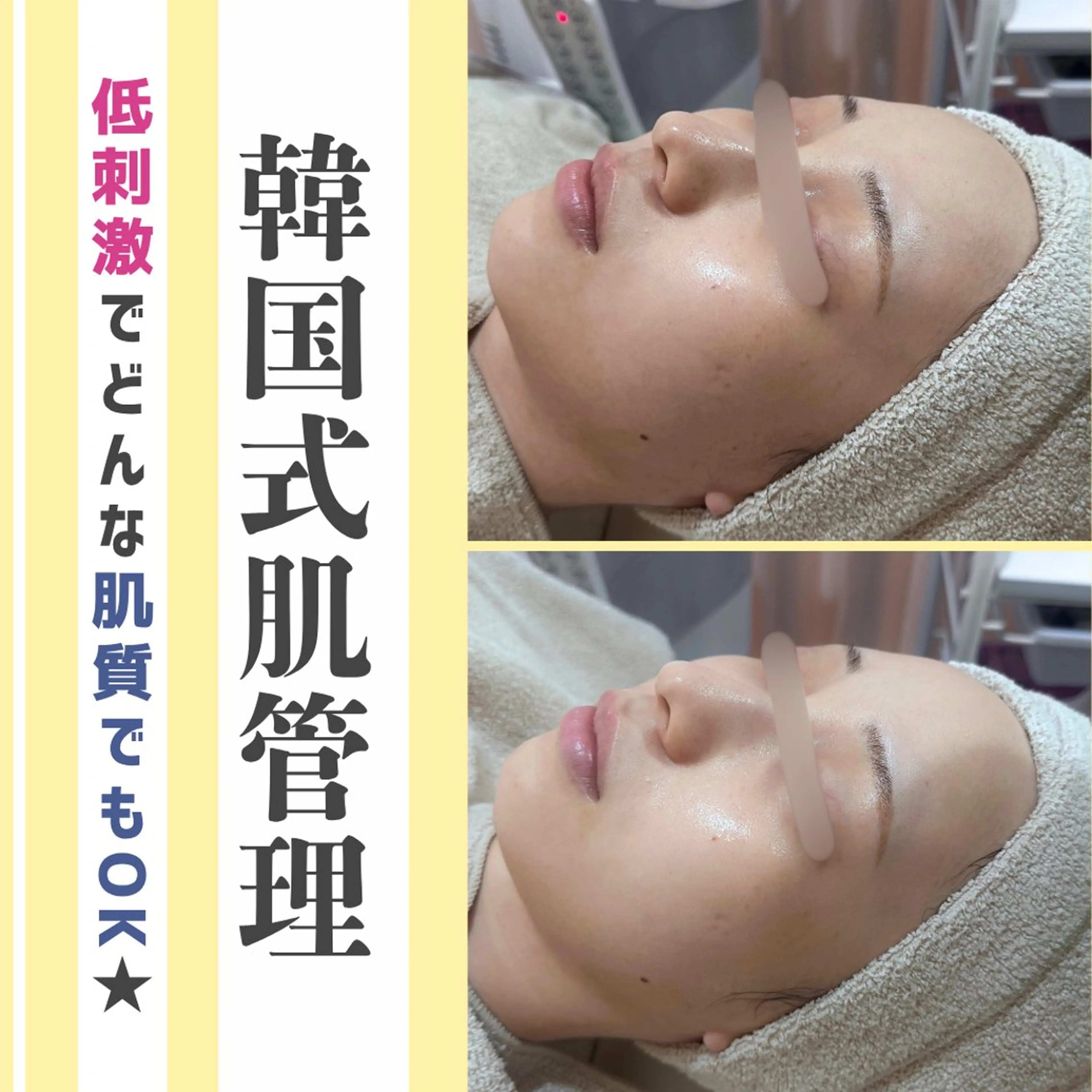 人気NO.2🤍〈韓国肌管理〉ララピール　(剥離&ダウンタイムなし) 60分5,000円の写真