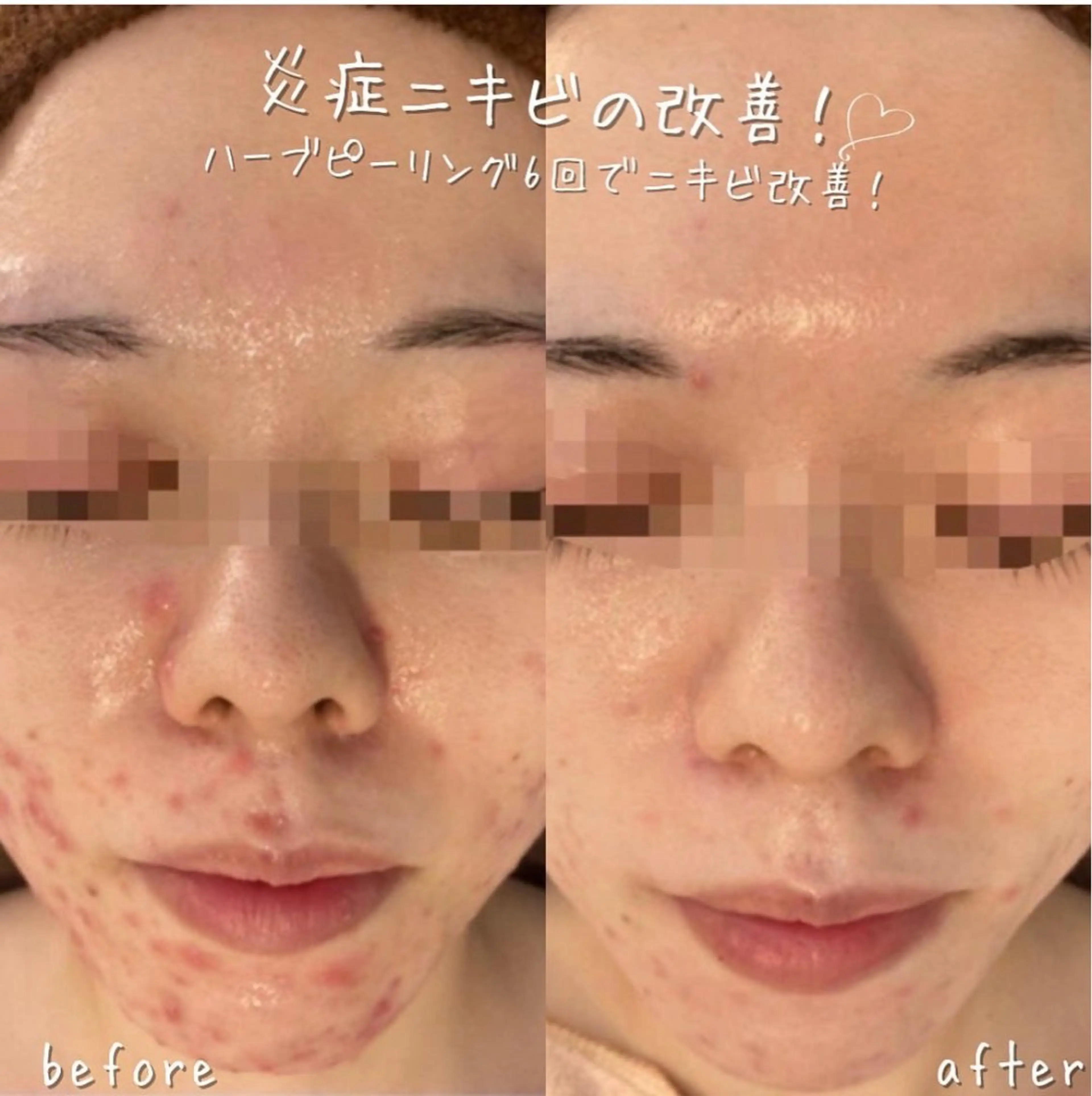 安心の看護師施術 ニキビ改善HAONのエステ・リラクイメージ