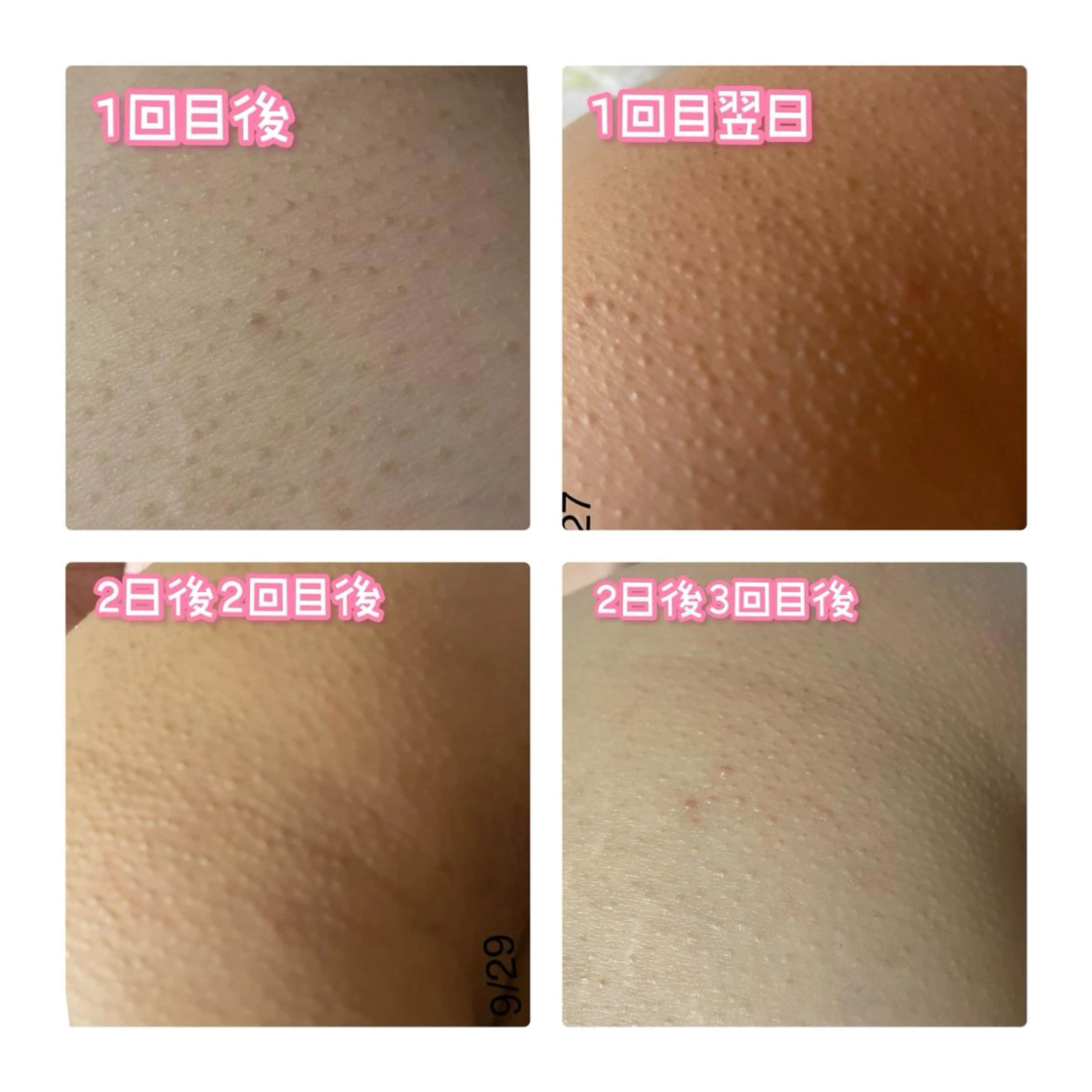 【女性限定】お尻の黒ずみぶつぶつ改善にお尻ゴマージュの写真