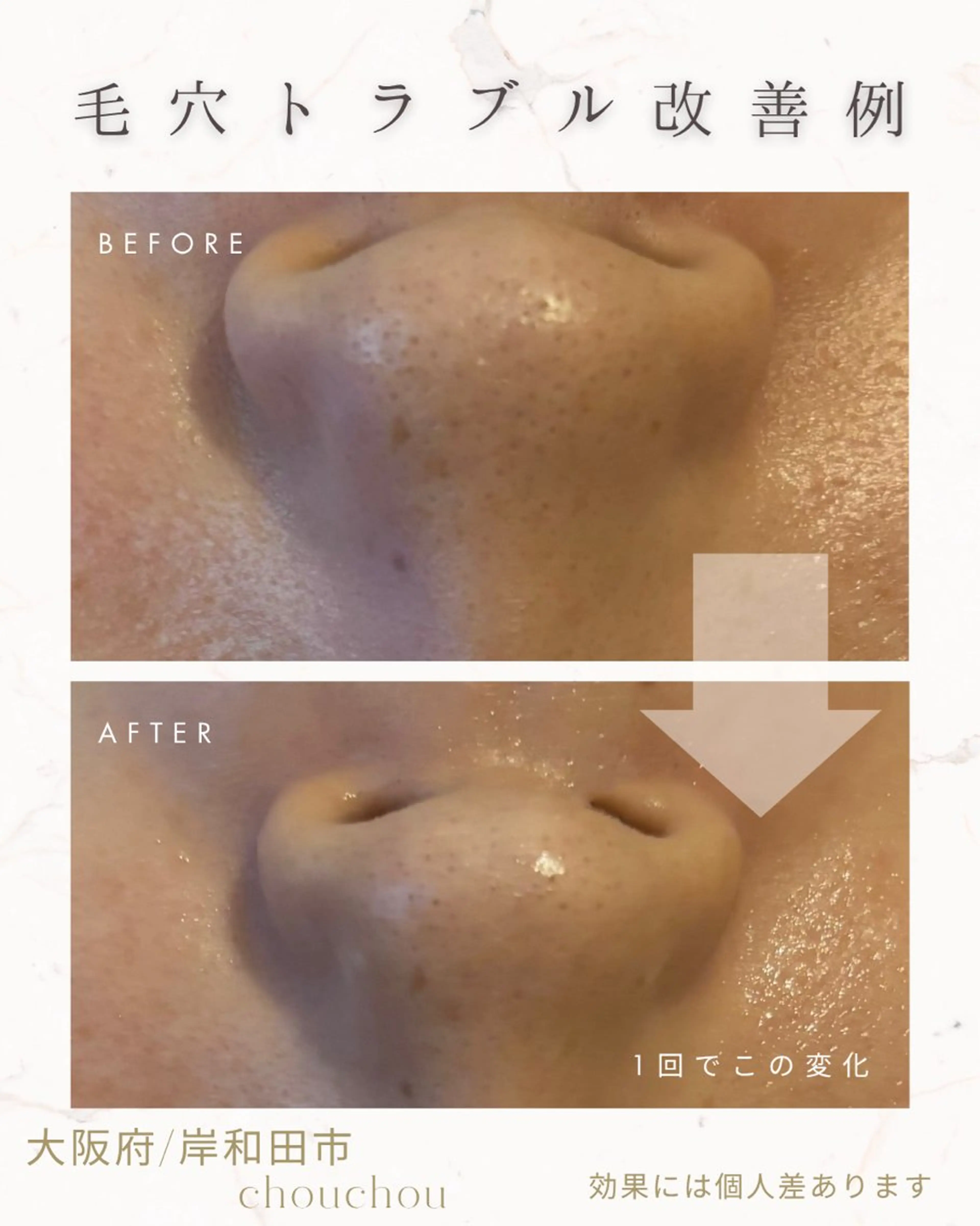 毛穴スッキリコース✨詰まり・開き・たるみにお悩みの方オススメ🫧の写真