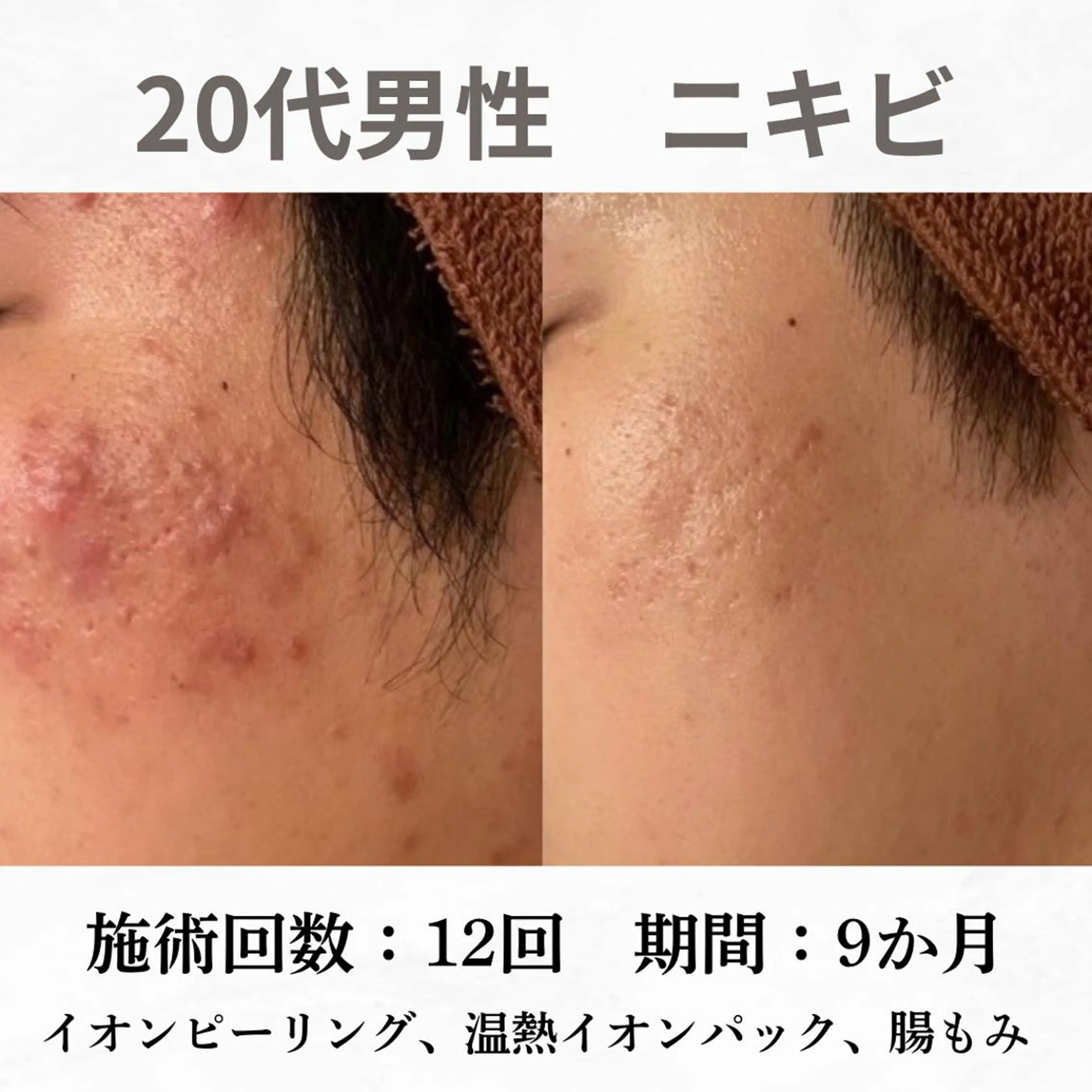 重度ニキビ専門🌷 ダウンタイムなしのエステ・リラクイメージ