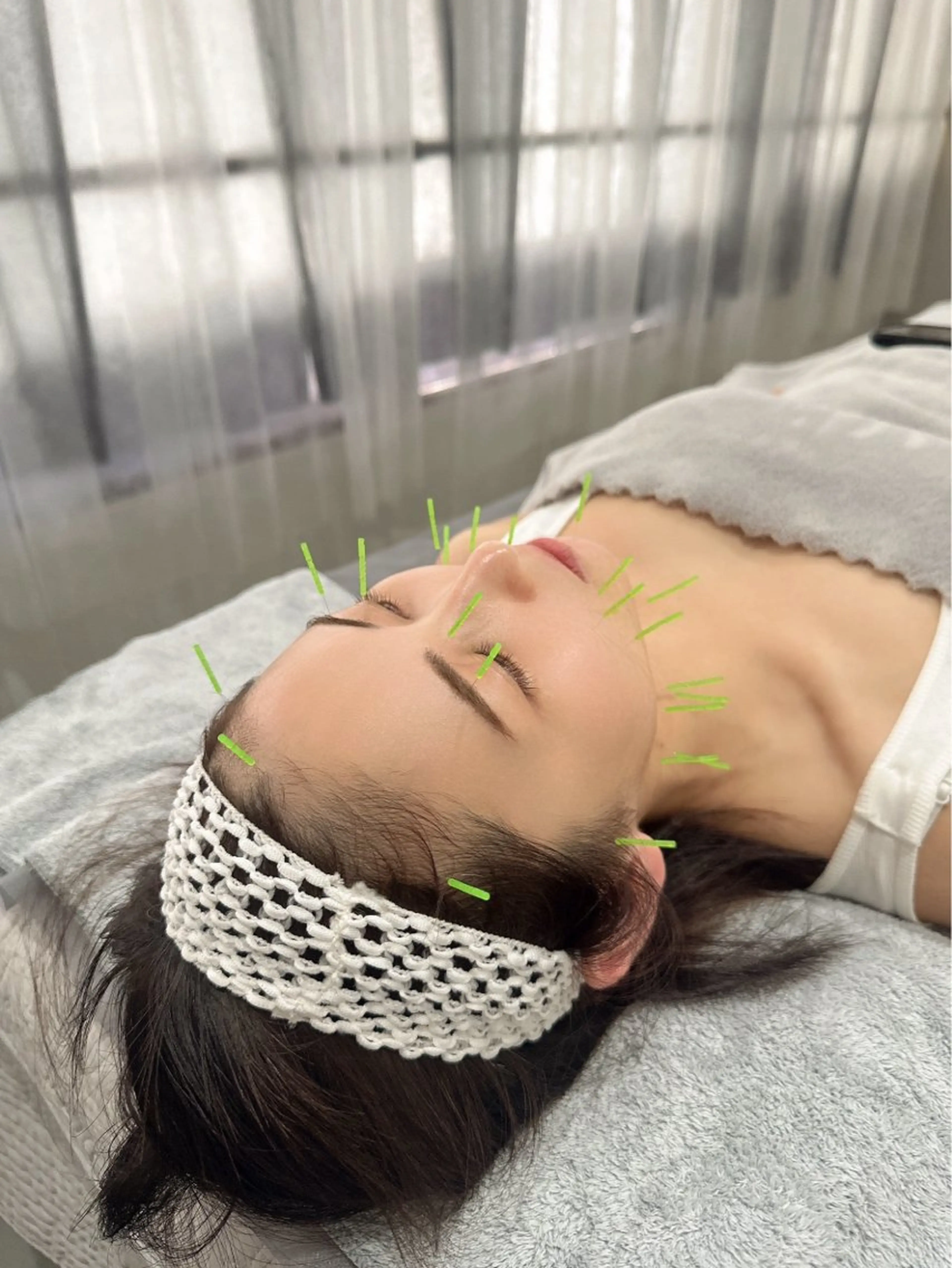 肌質改善✳︎美顔鍼×ハーブピーリングの写真