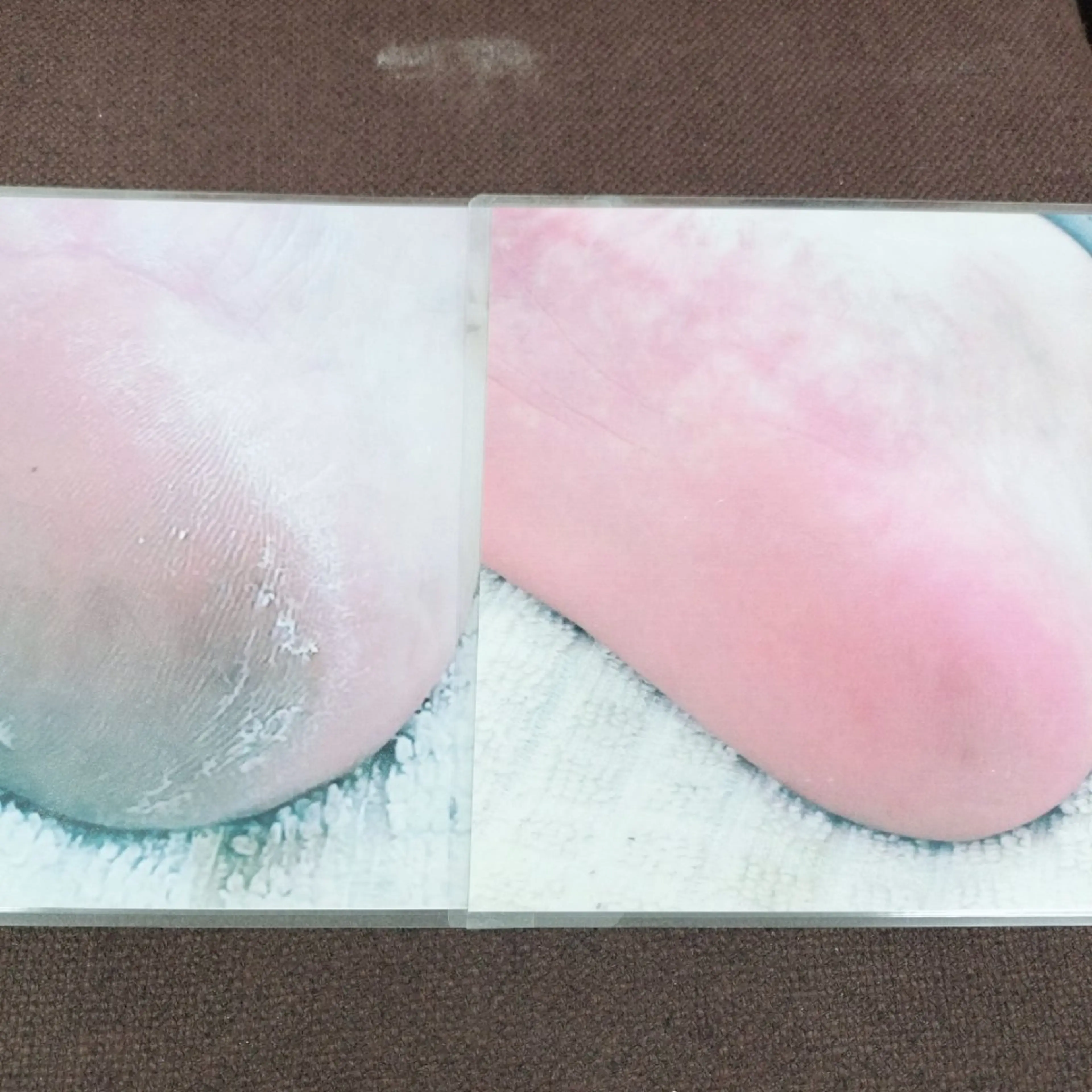 足の角質除去の写真