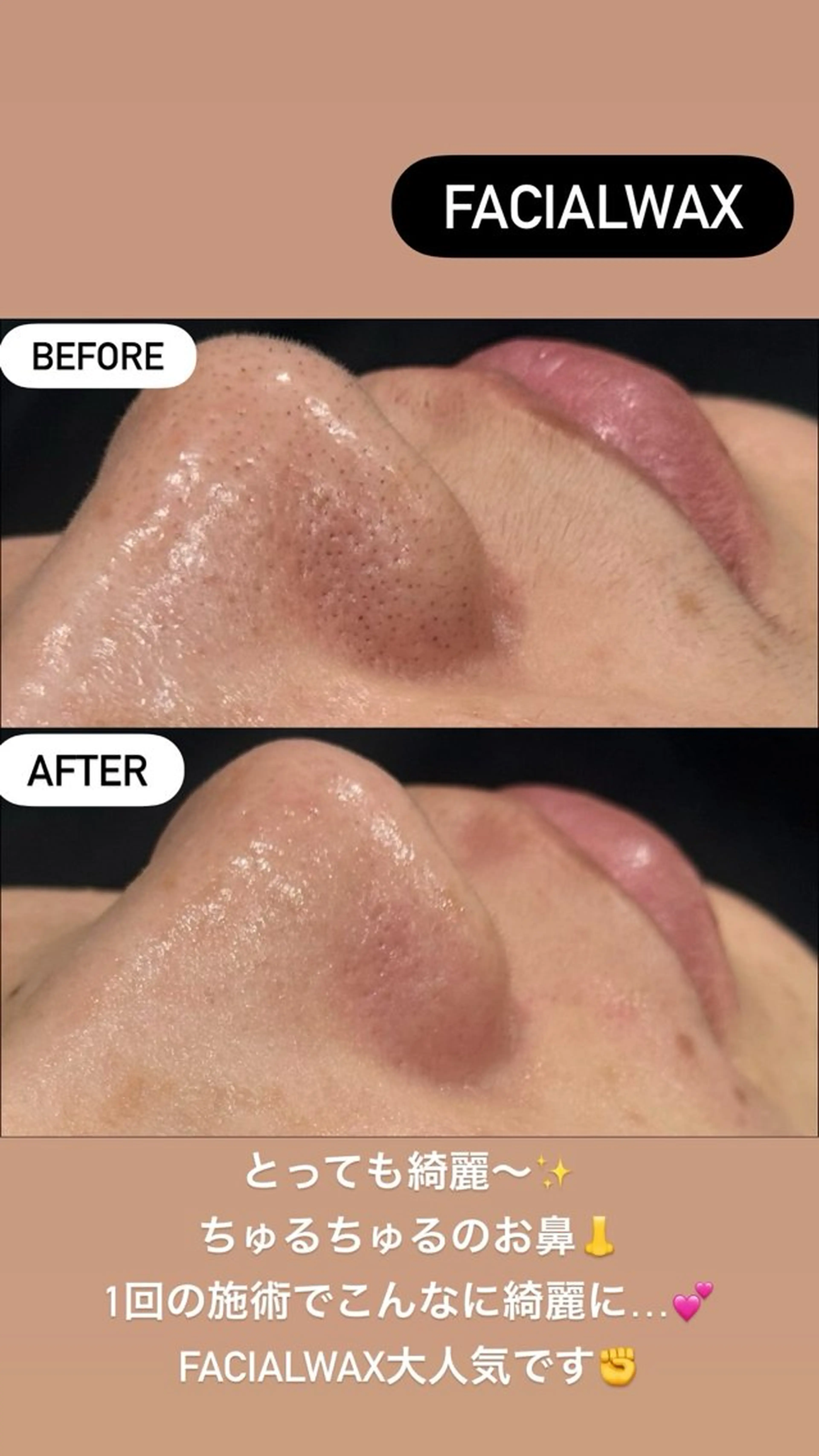 【新春お年玉】部分Wax+毛穴洗浄+LED肌管理パック ¥6,800→¥5,800の写真