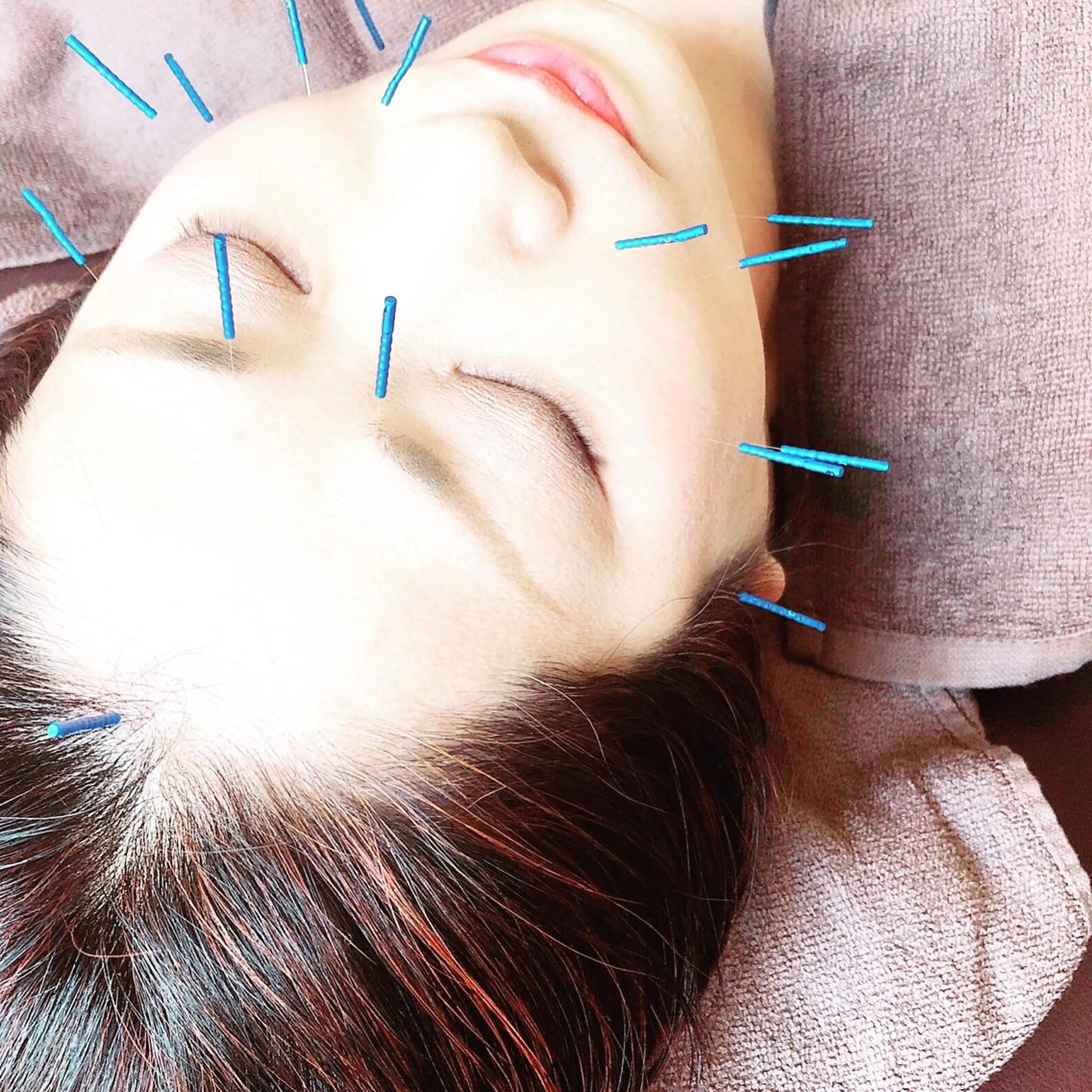 ◆美容鍼◆お顔を綺麗な肌やリフトアップに！期間限定料金になります。の写真