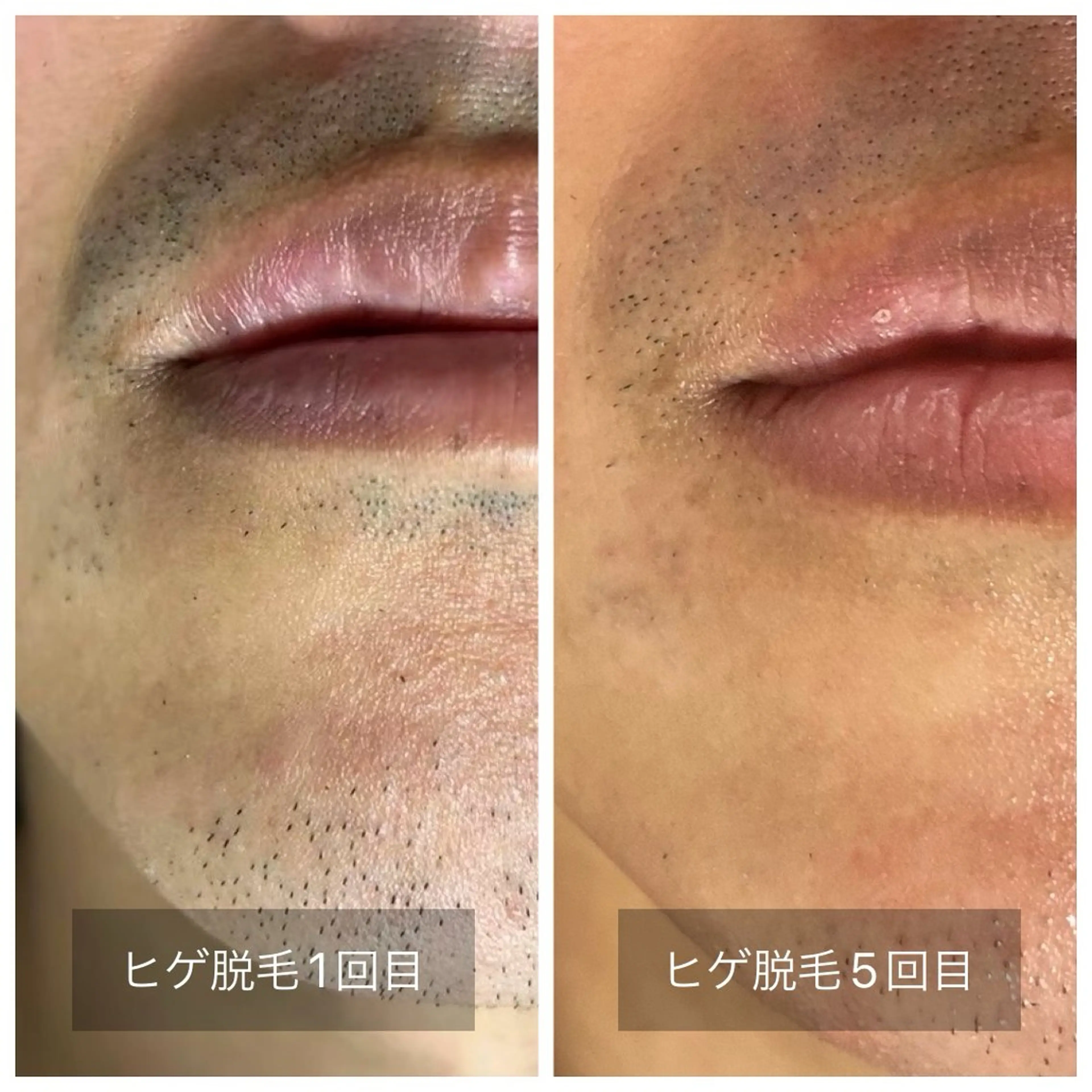 メンズ 脱毛 エマニエル USAのエステ・リラクイメージ