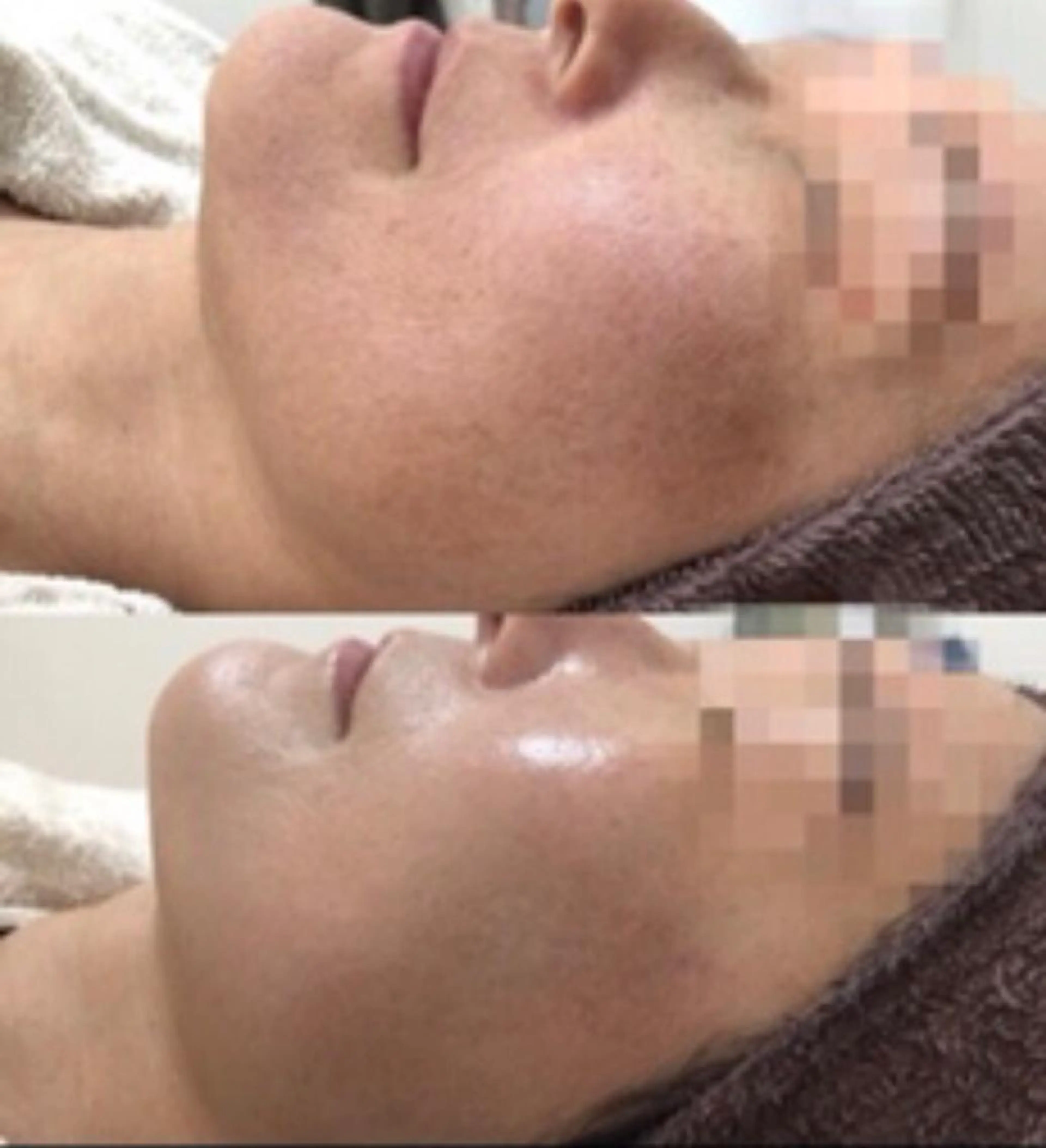 皮膚科学に基づいたハーブピーリング 🌿の写真