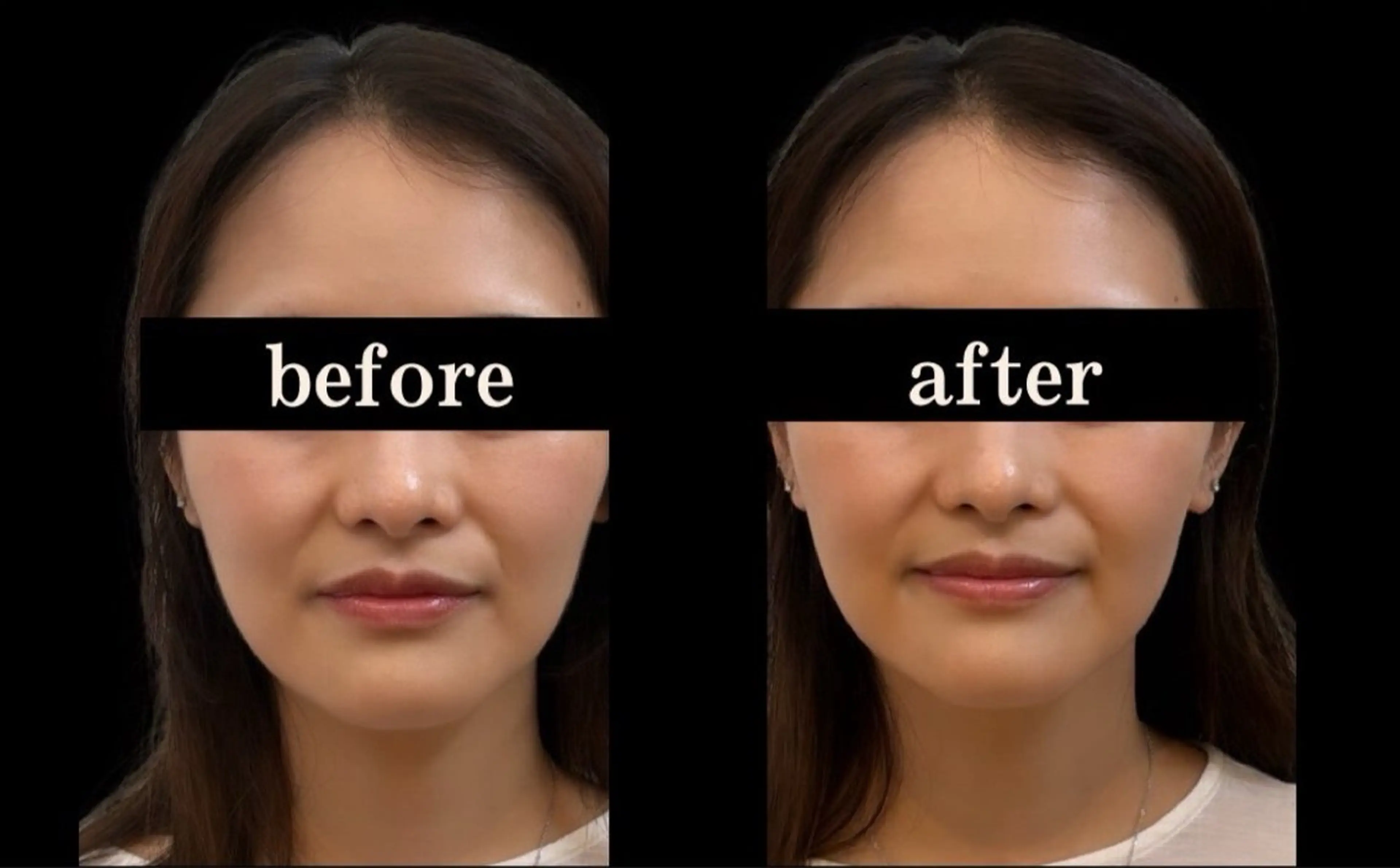 小顔/たるみ/黒ずみ除去専門サロン/SONA 大和西大寺店所属・【小顔専門看護師 サロンSONA】のエステ・リラクイメージ