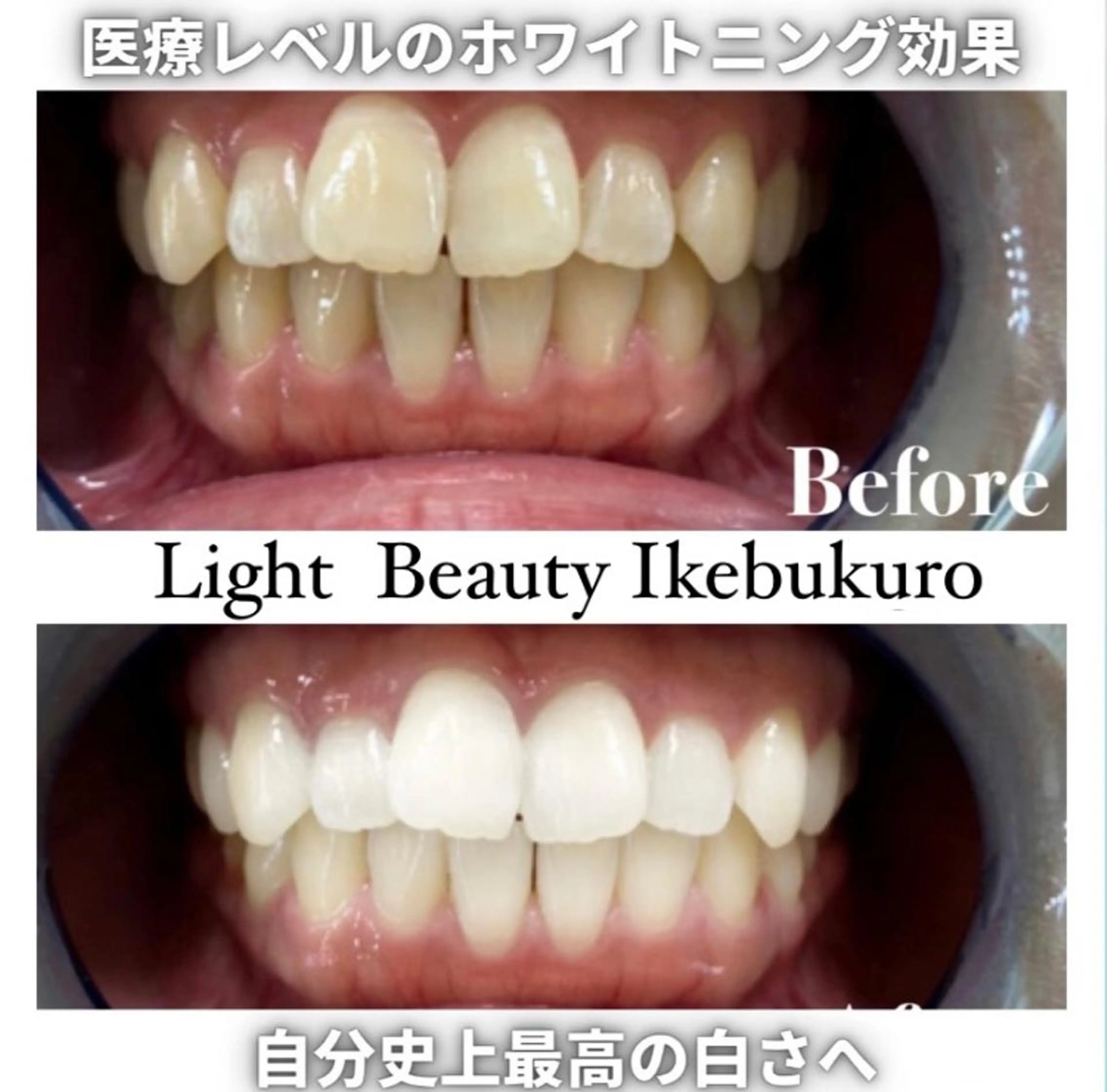 もっと激白ホワイトニング‼️圧倒的な白さ✨✨Wホワイトニング✨✨《合計110分照射3来店コース》✨🦷✨の写真