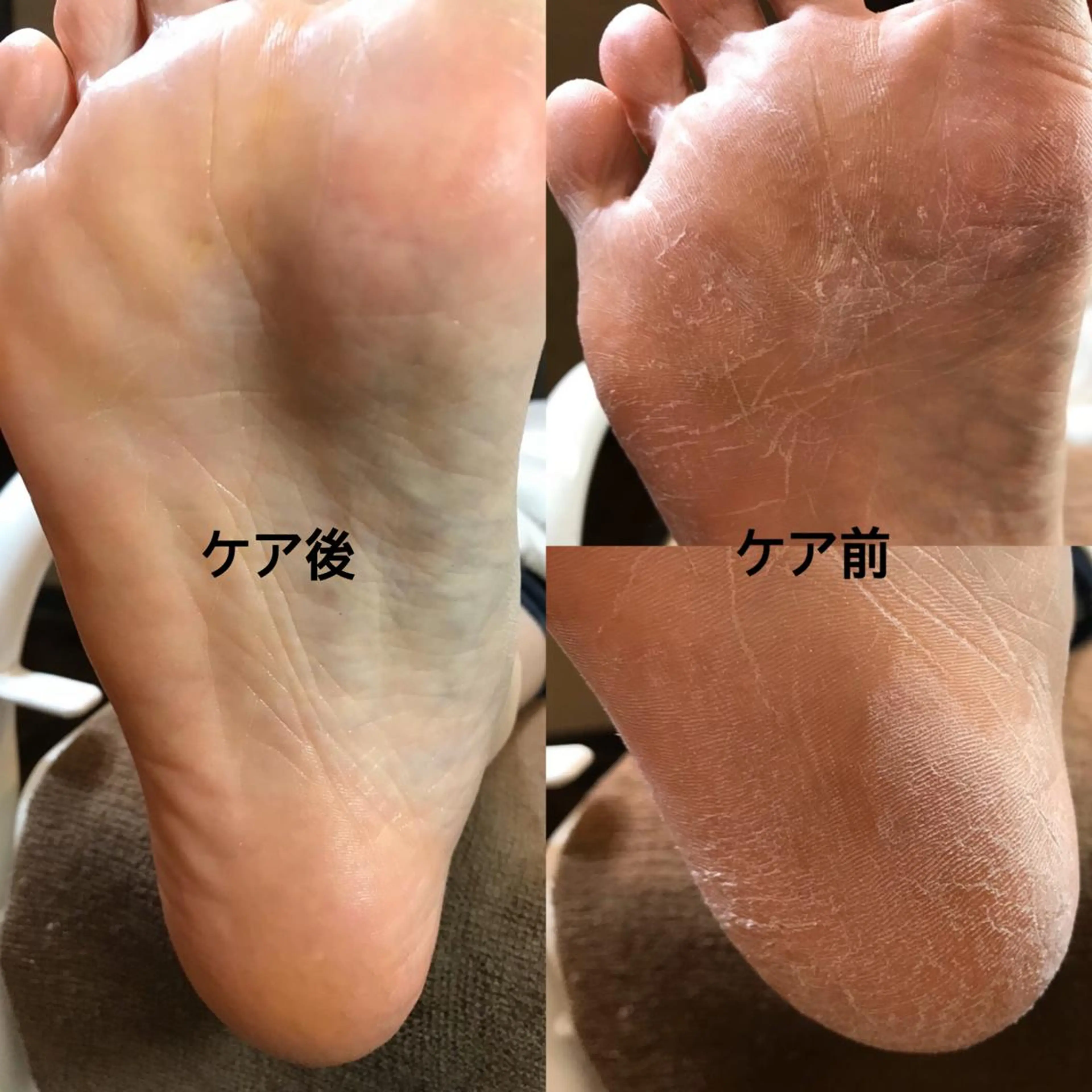 フット足裏角質ケア☆かかとツルツルケア　(フットバス込み)の写真